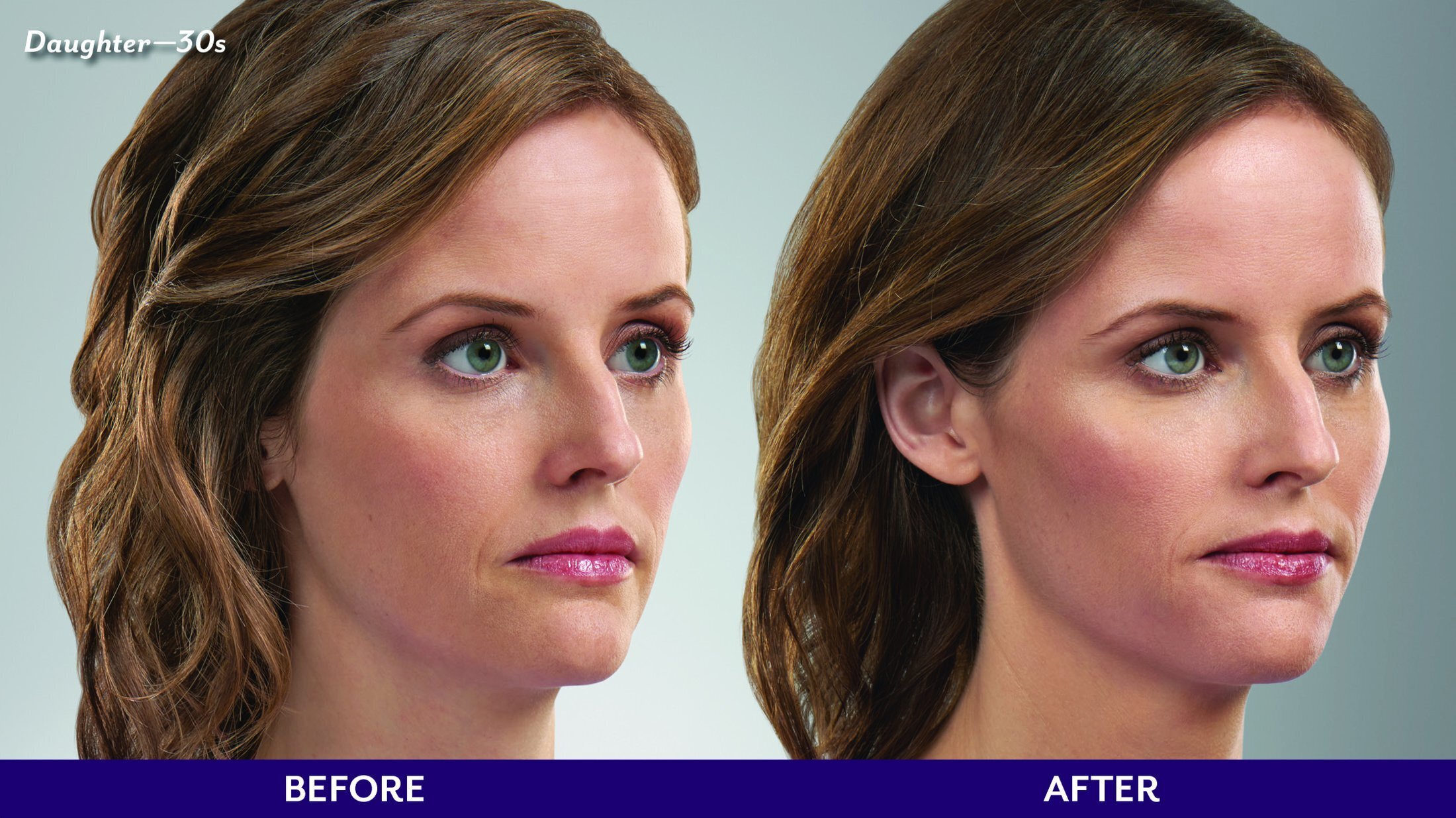 Grand Rapids JUVÉDERM VOLUMA XC model