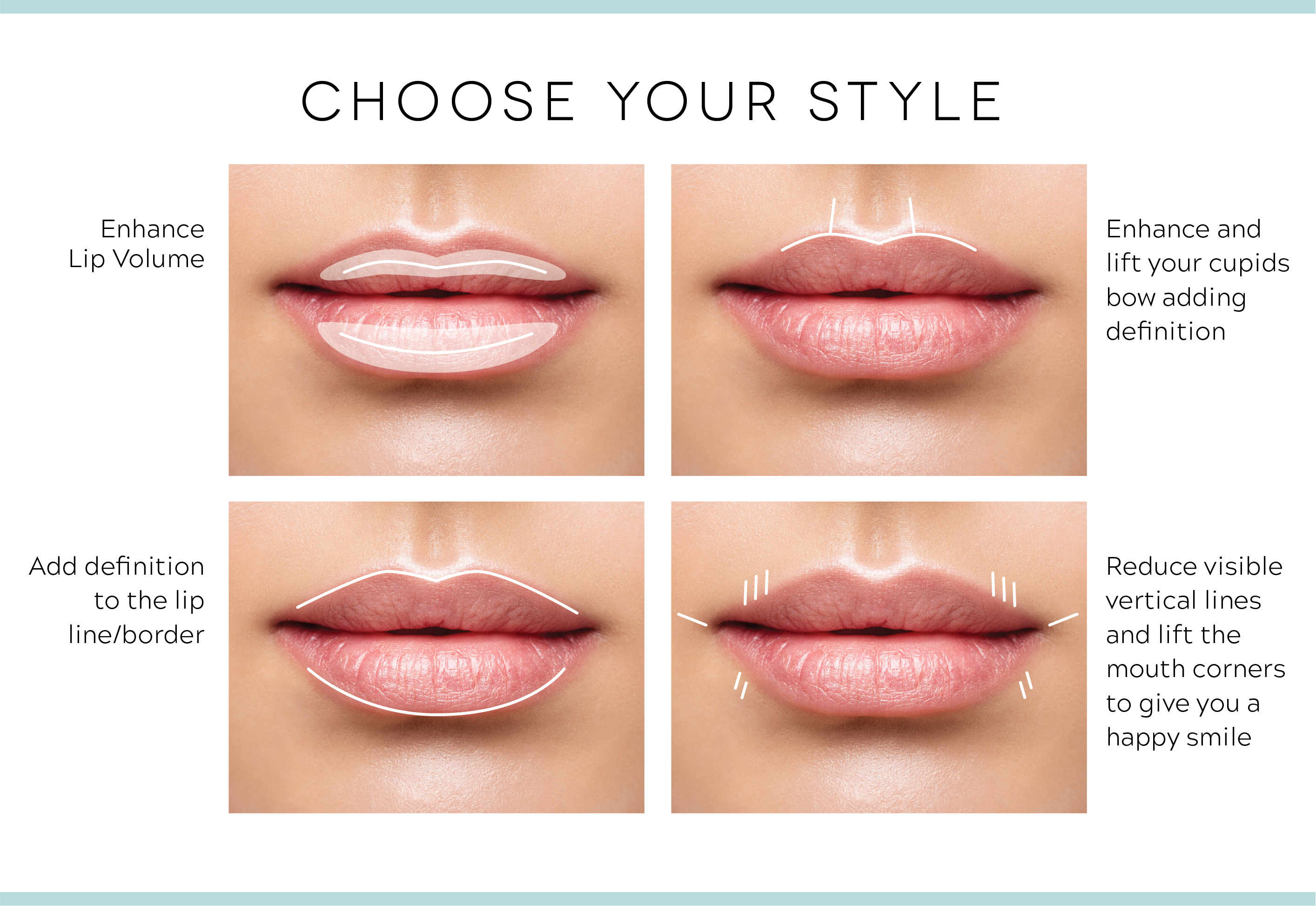 Grand Rapids lip injections, four pairs of lips