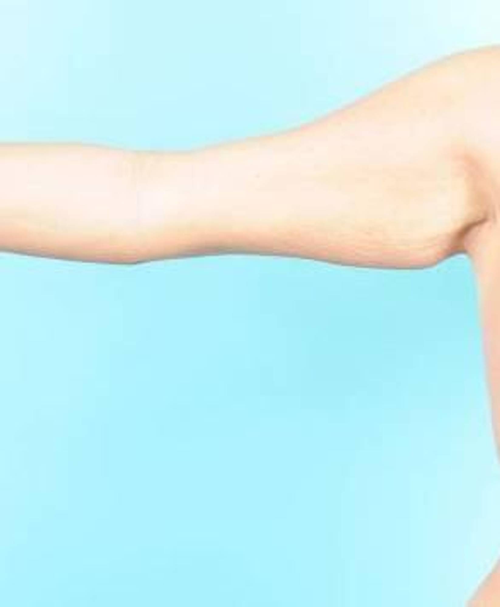 Arm Lift Before & After Image