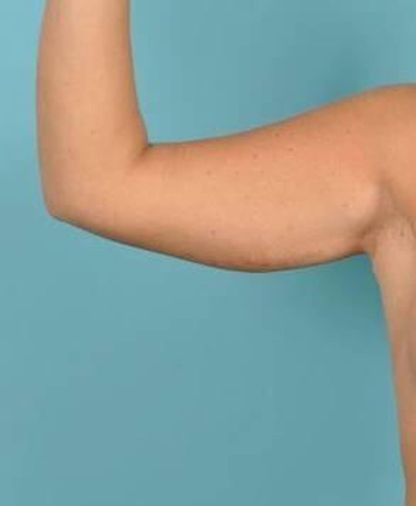 Arm Lift Before & After Image