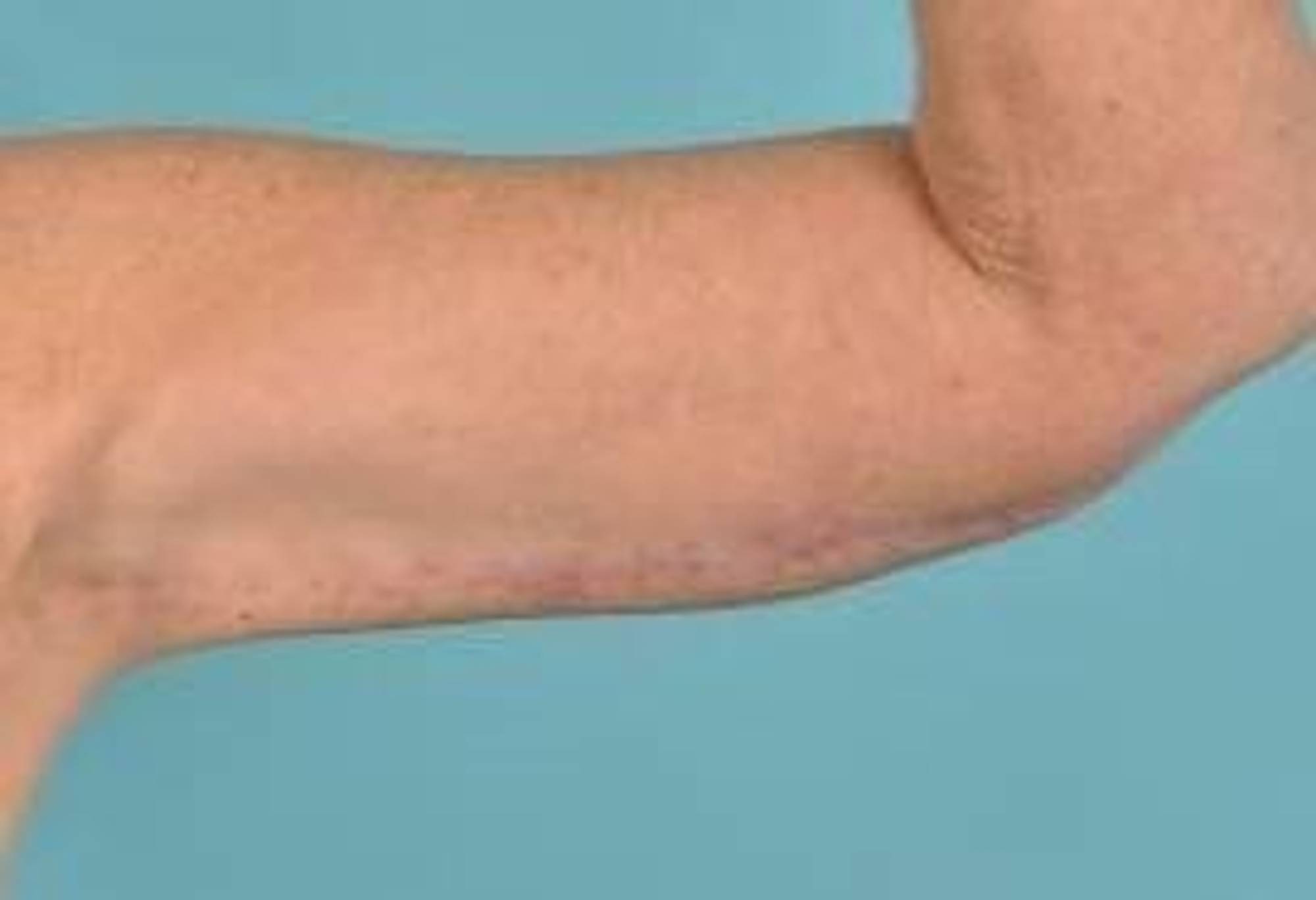 Arm Lift Before & After Image