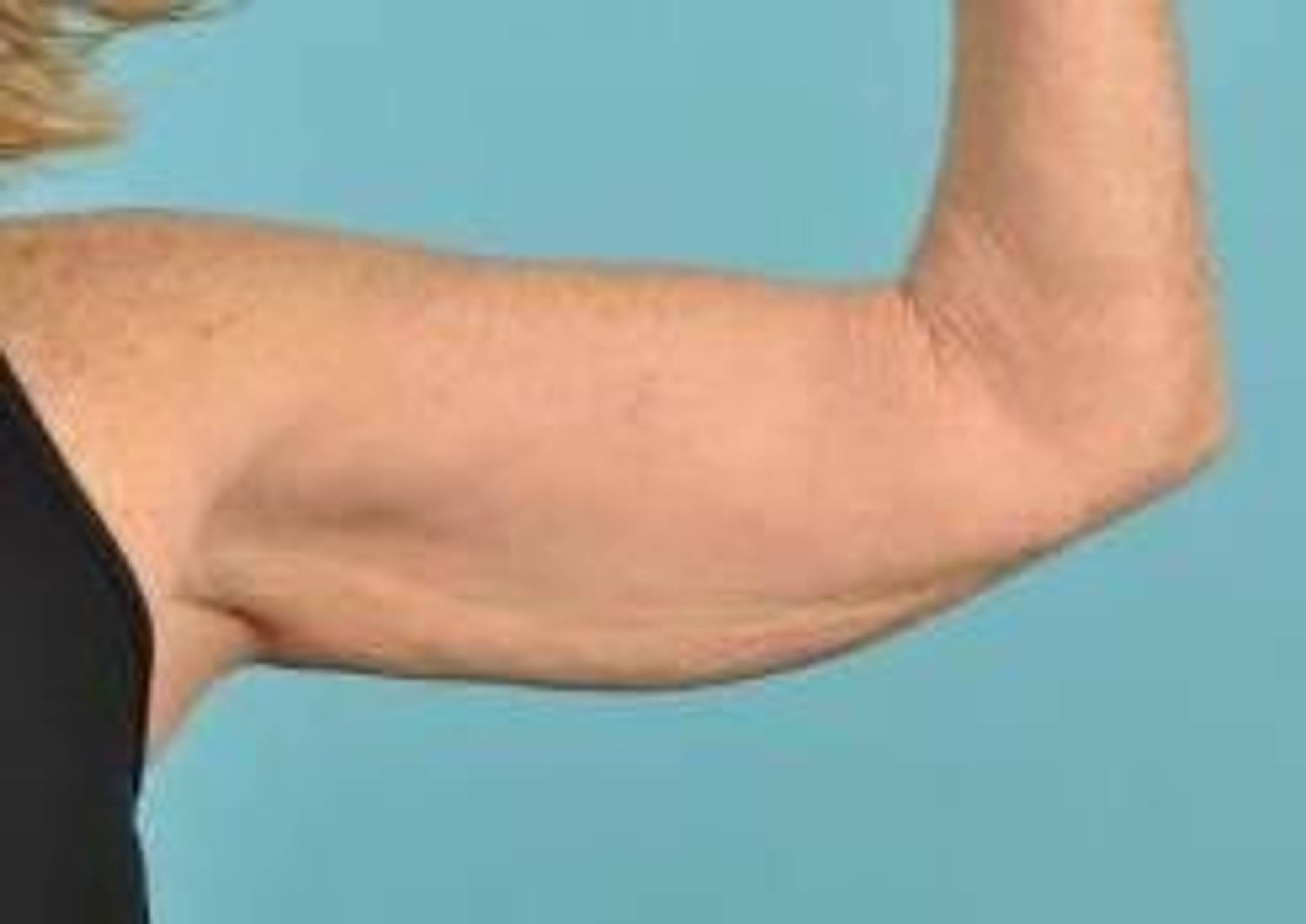 Arm Lift Before & After Image