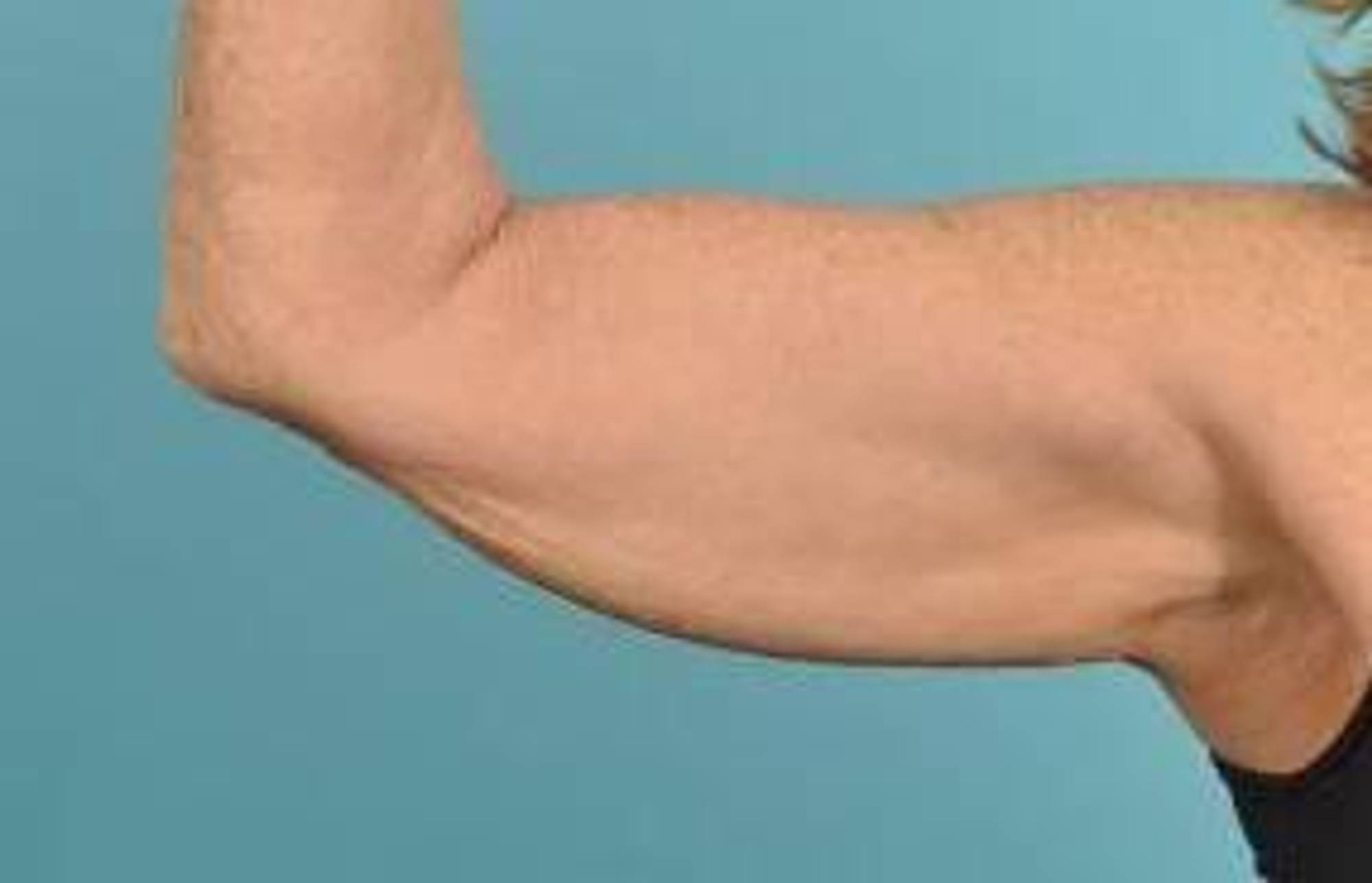 Arm Lift Before & After Image