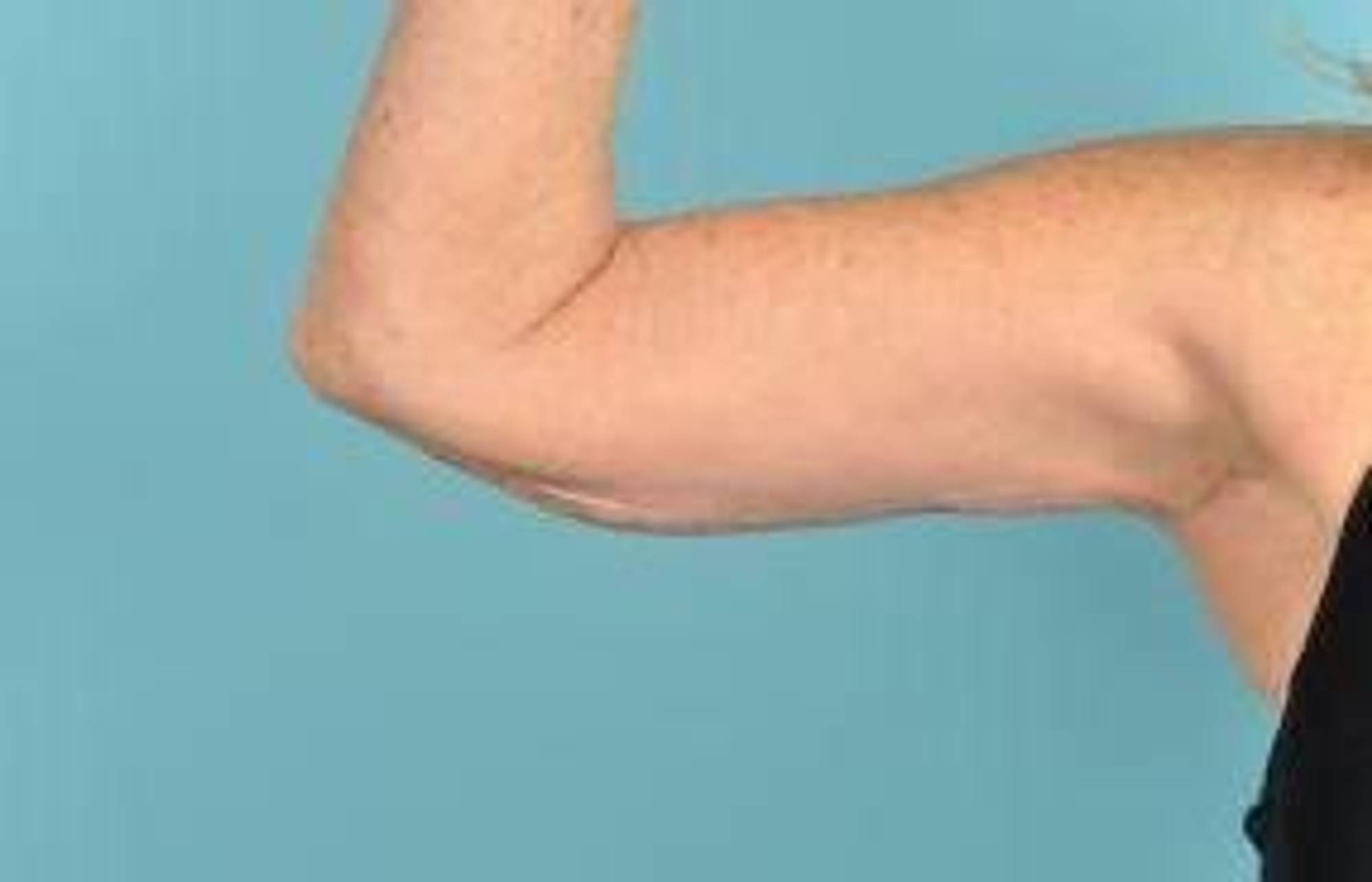 Arm Lift Before & After Image