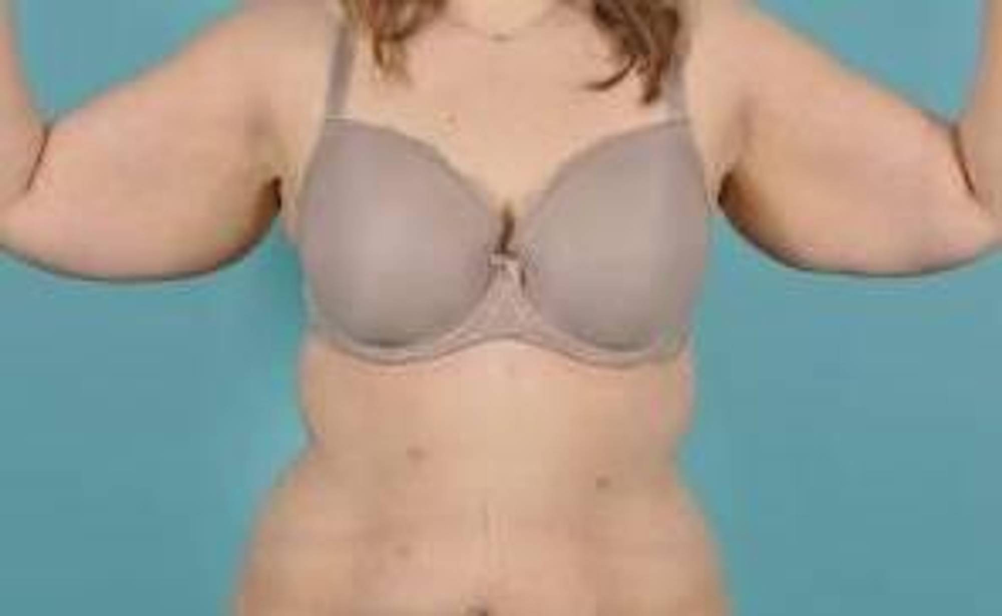 Arm Lift Before & After Image