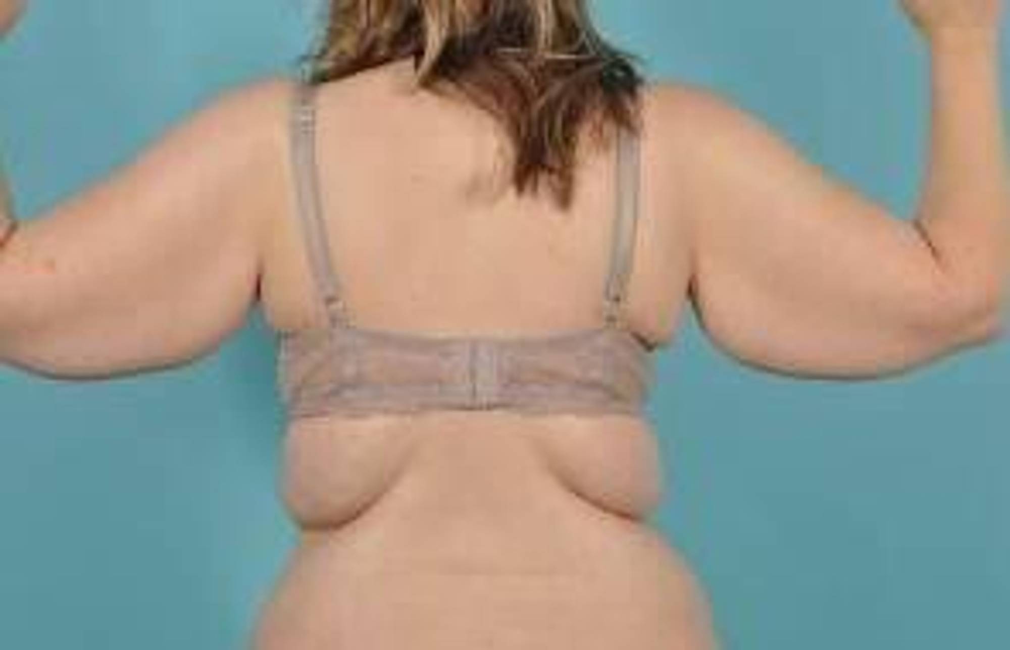 Arm Lift Before & After Image