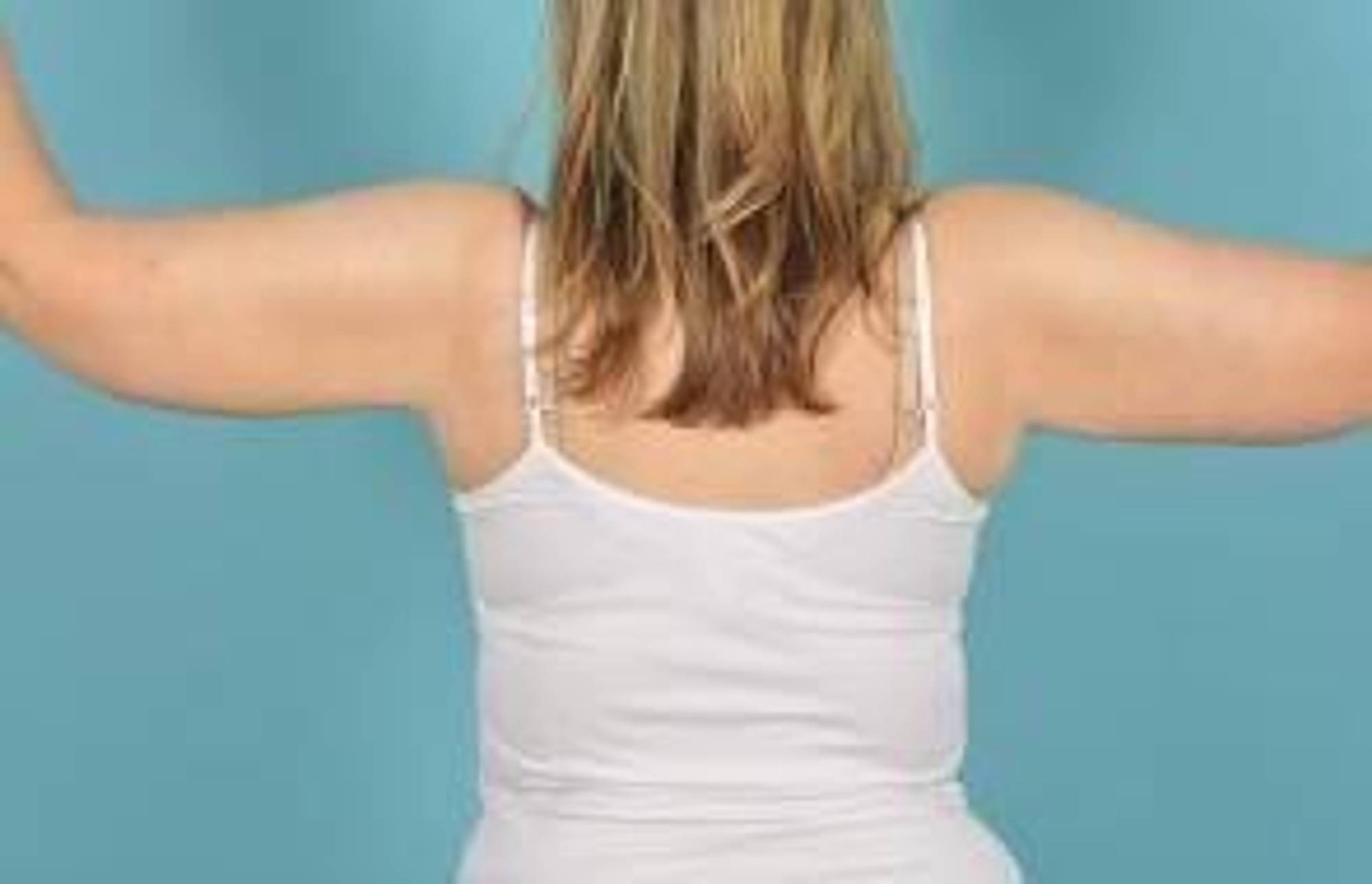 Arm Lift Before & After Image