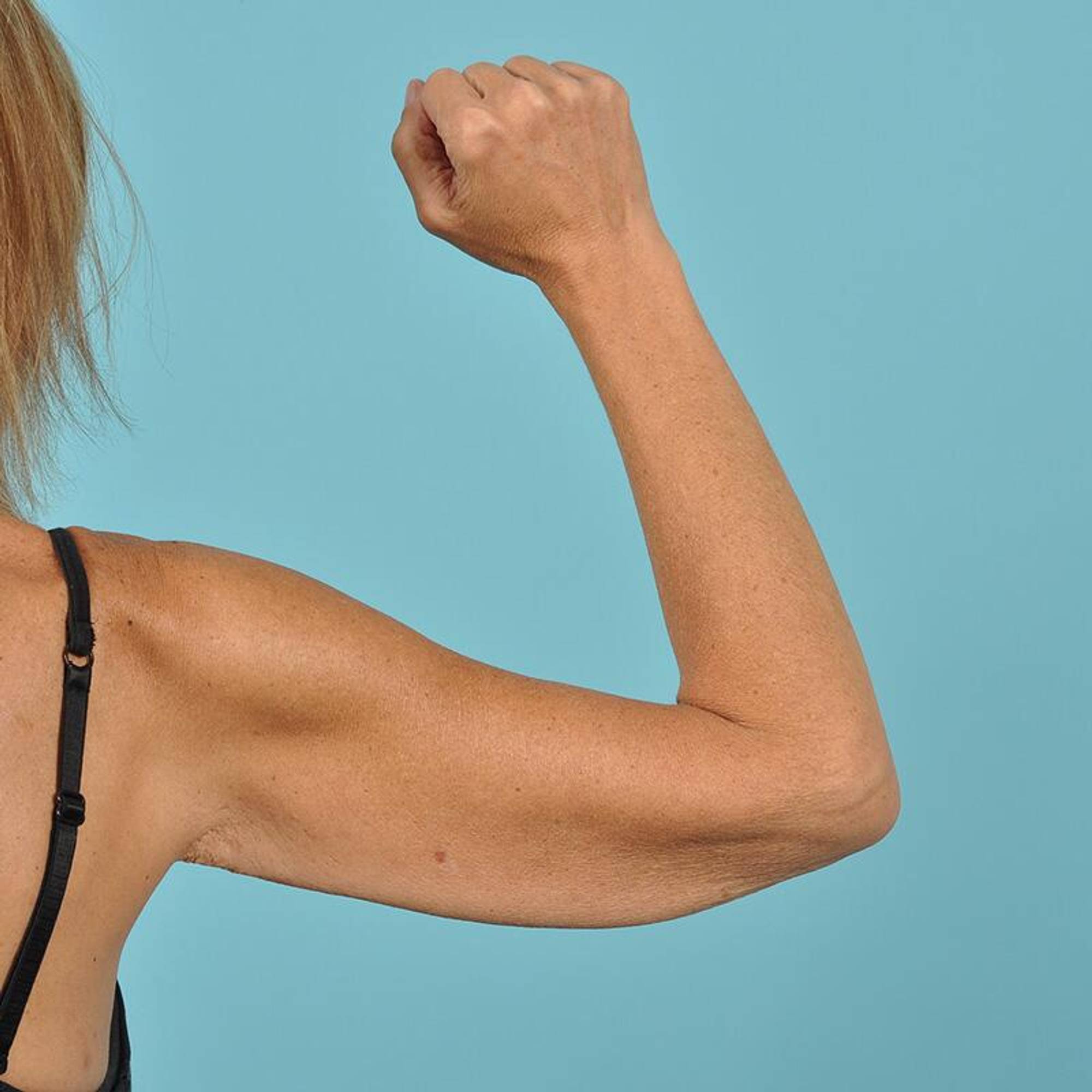 Arm Lift Before & After Image