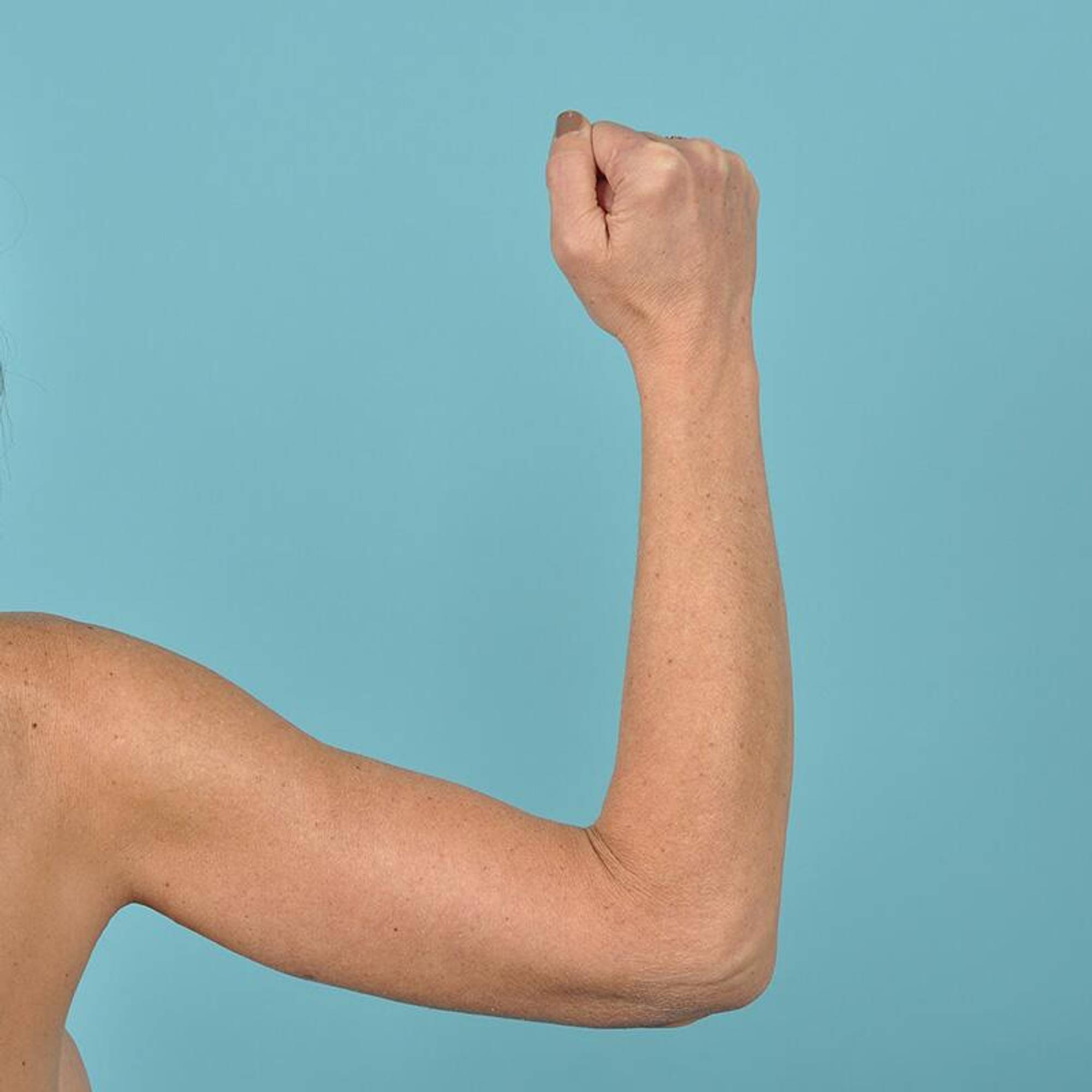 Arm Lift Before & After Image