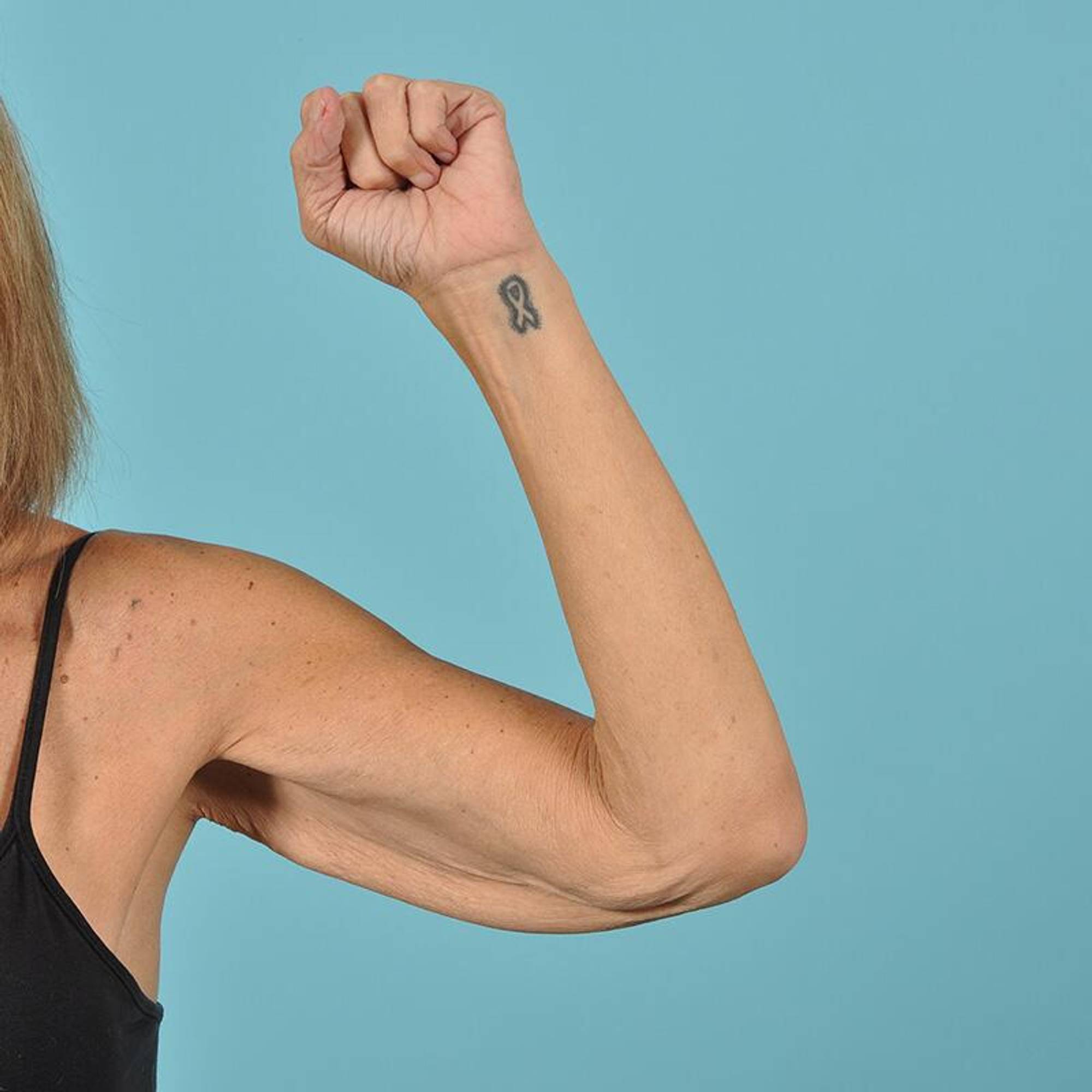 Arm Lift Before & After Image