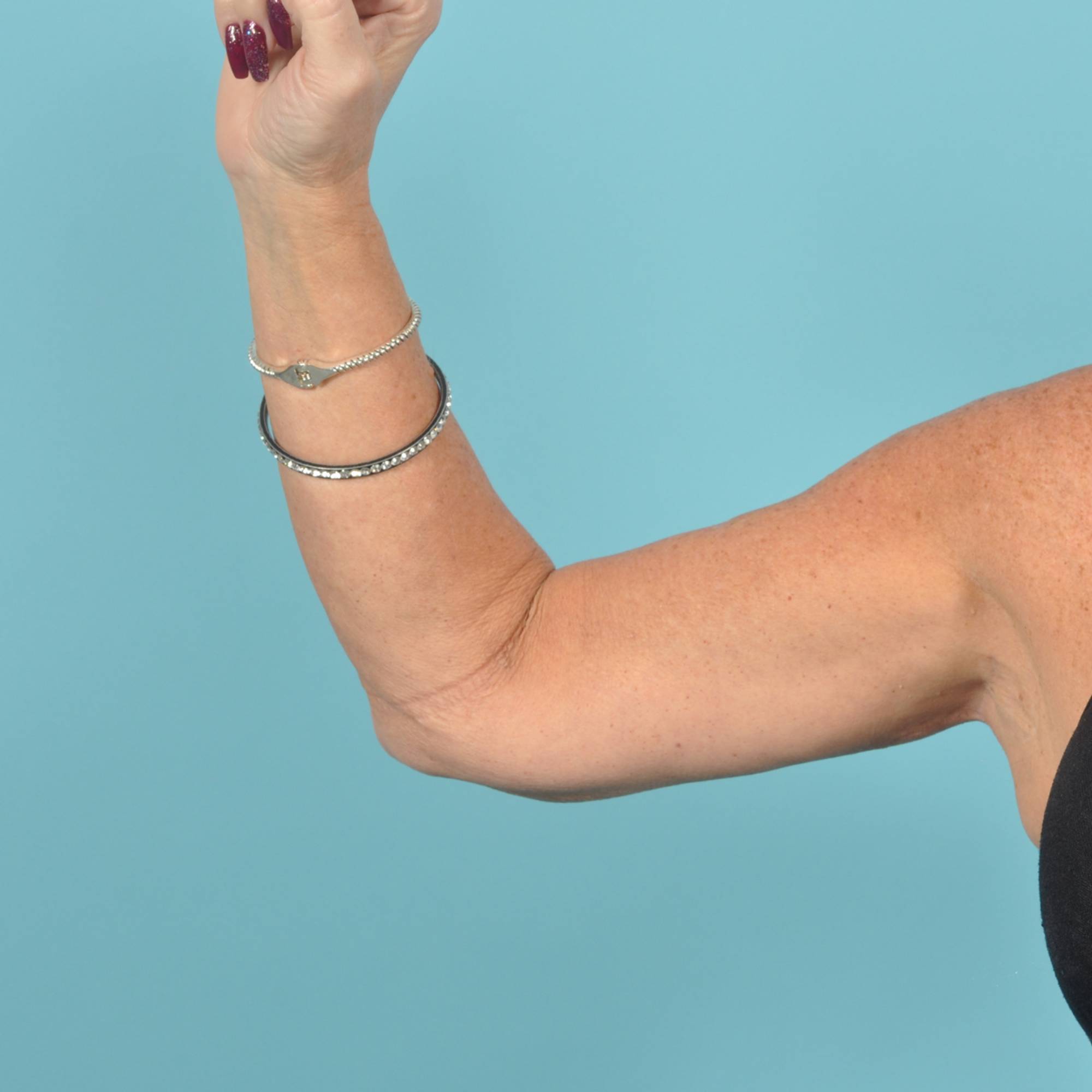 Arm Lift Before & After Image