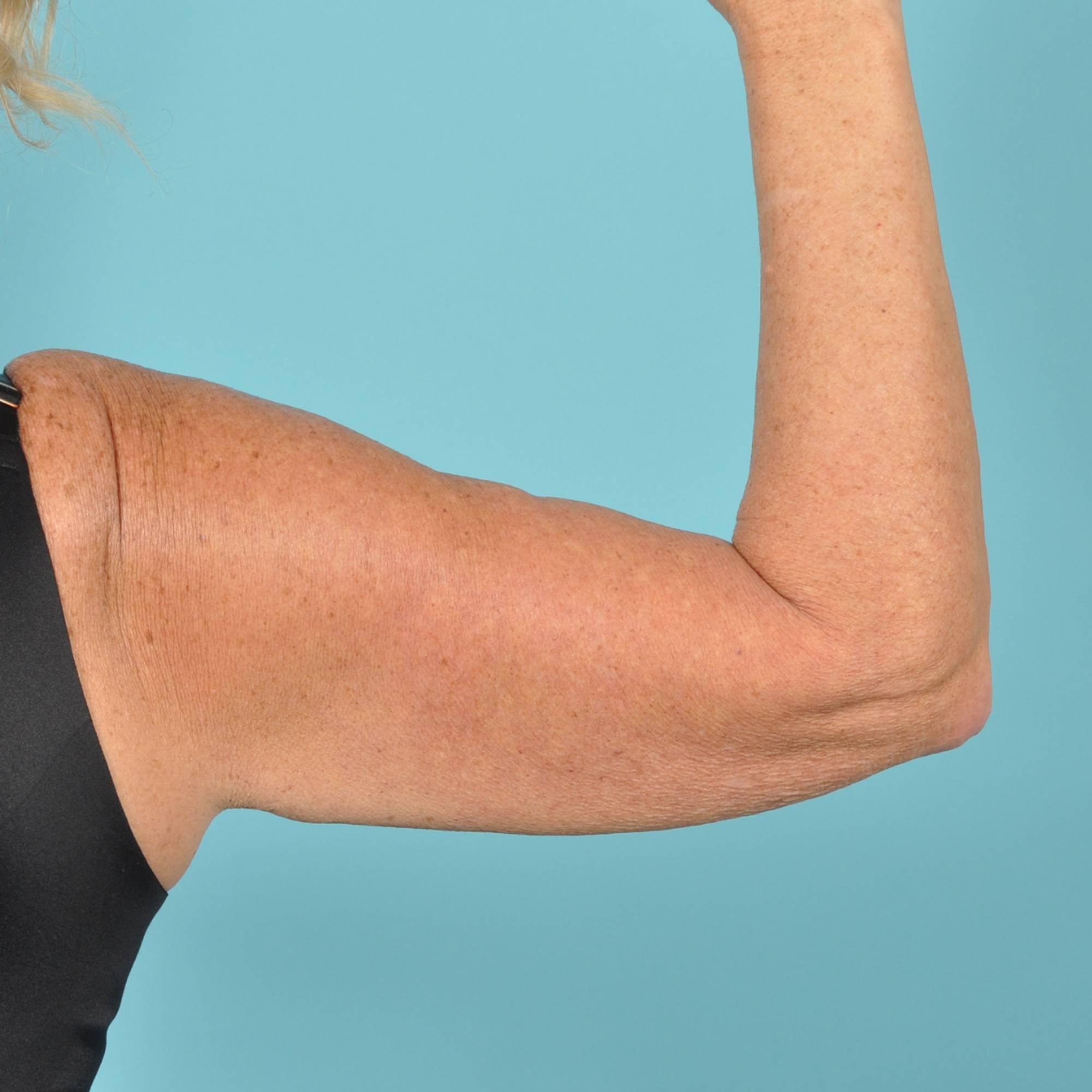 Arm Lift Before & After Image