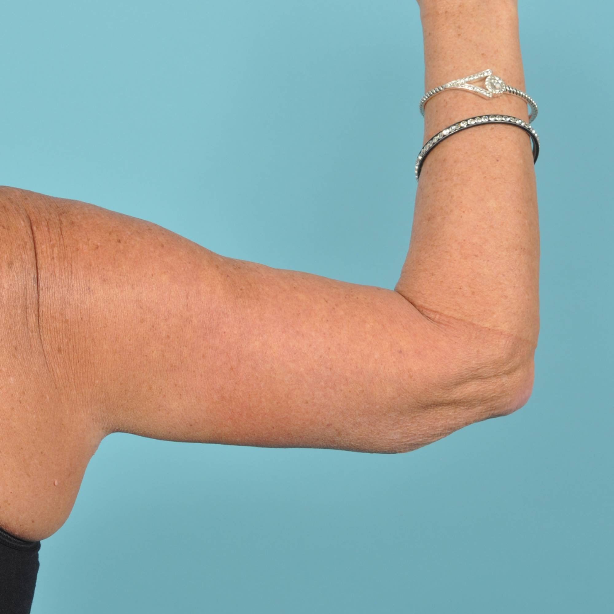 Arm Lift Before & After Image