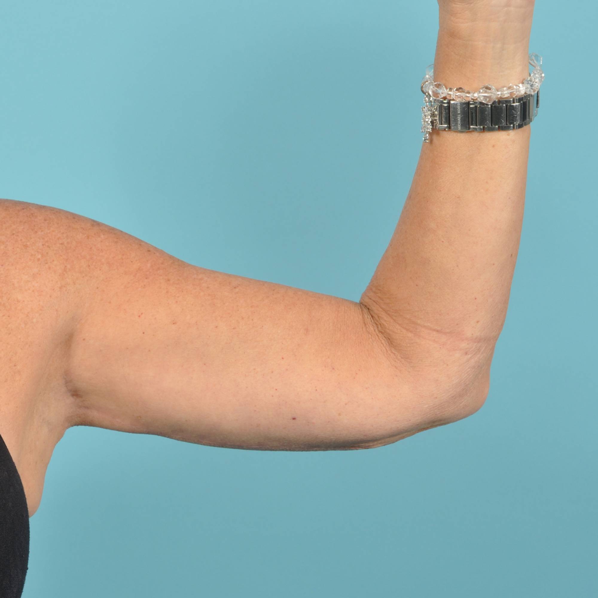 Arm Lift Before & After Image