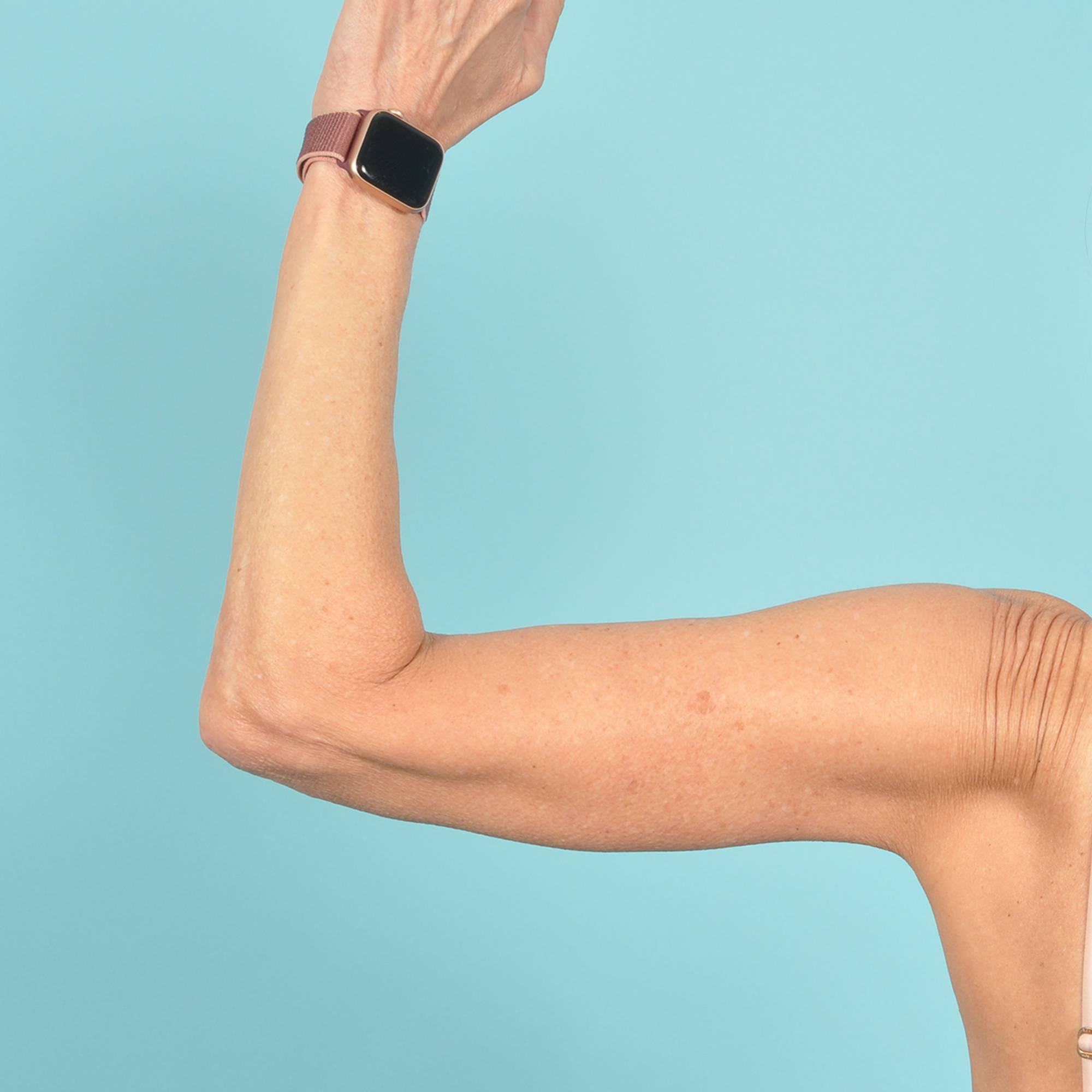 Arm Lift Before & After Image