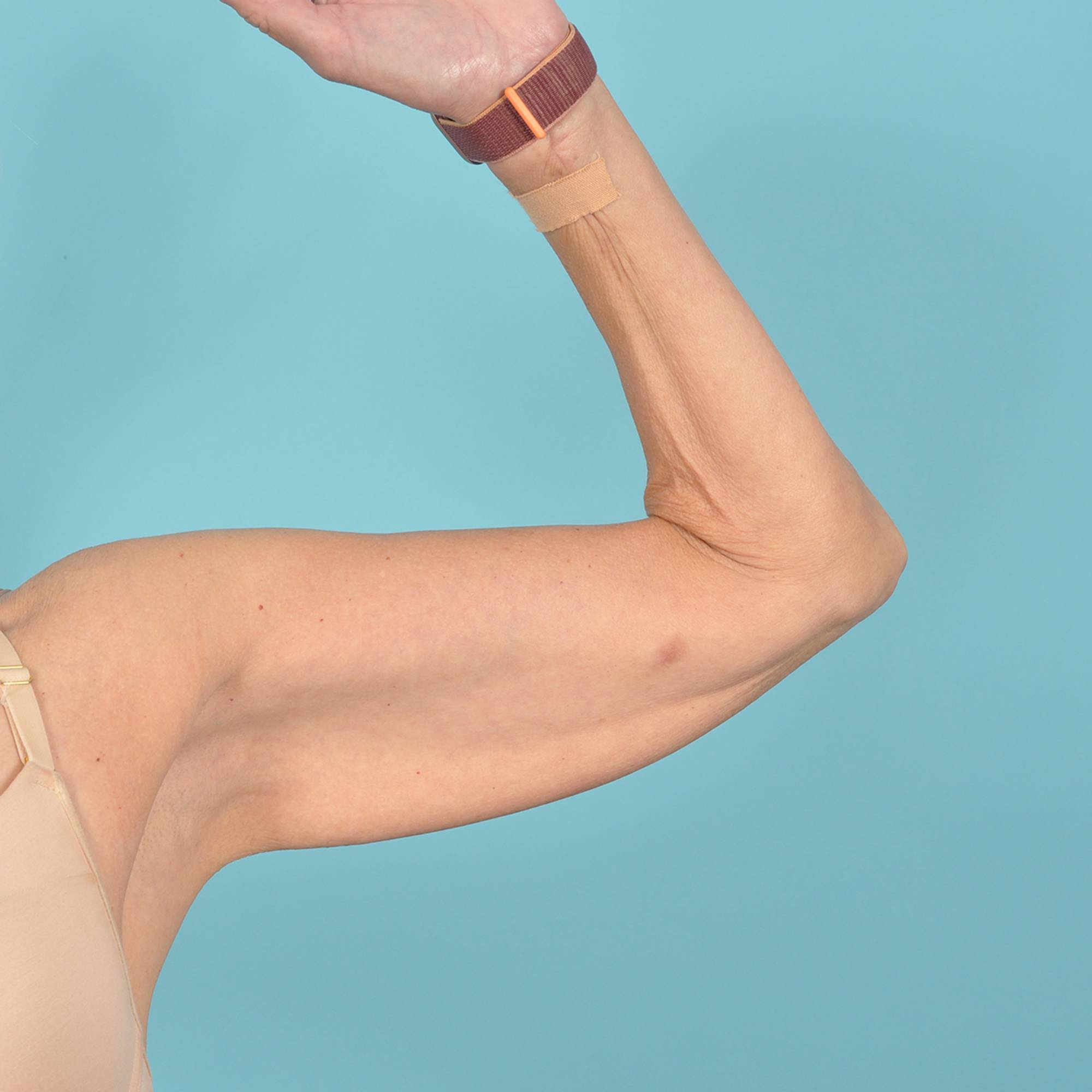 Arm Lift Before & After Image