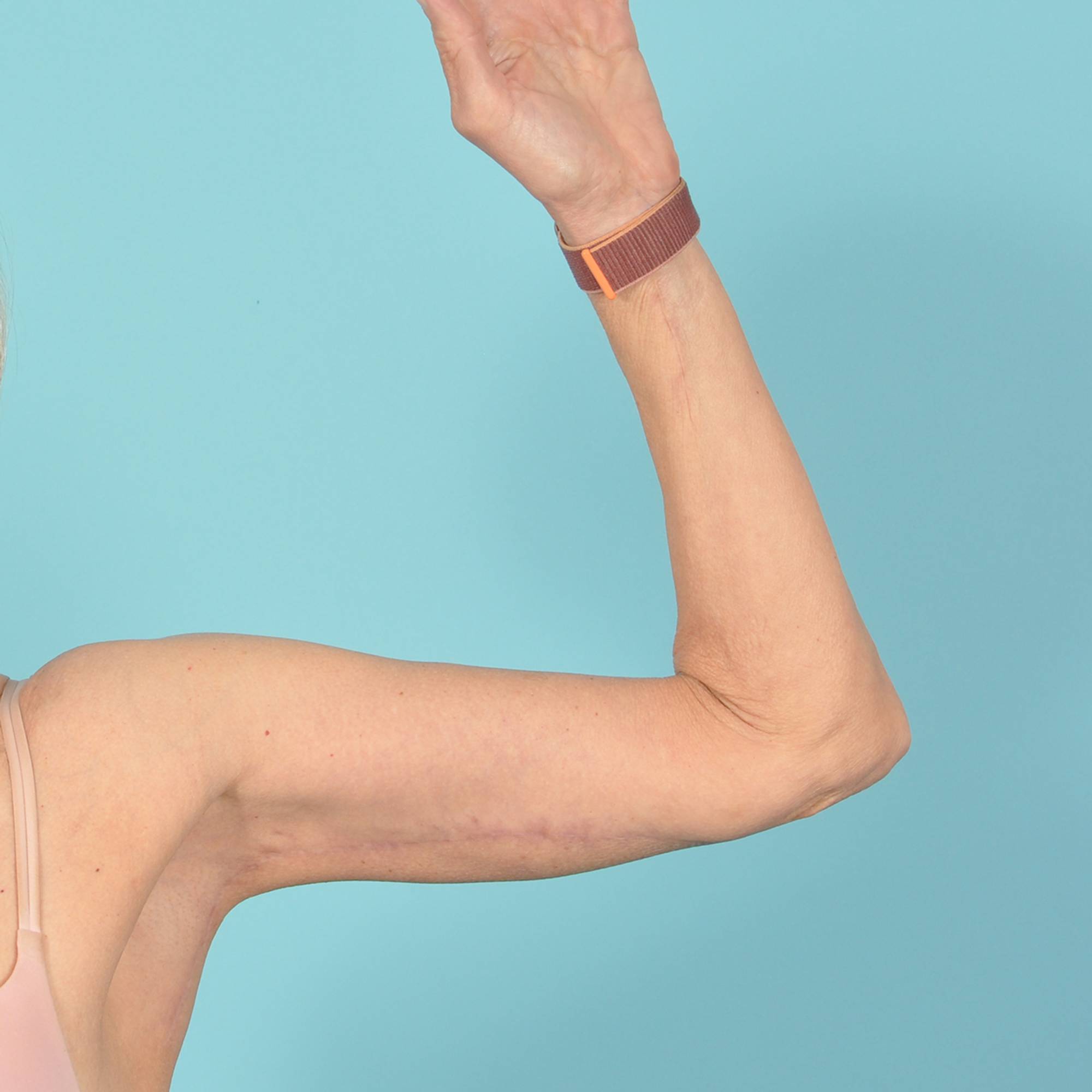 Arm Lift Before & After Image