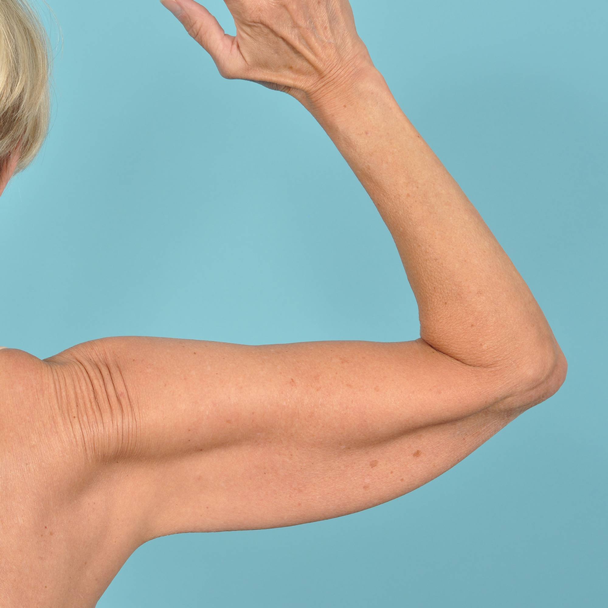 Arm Lift Before & After Image