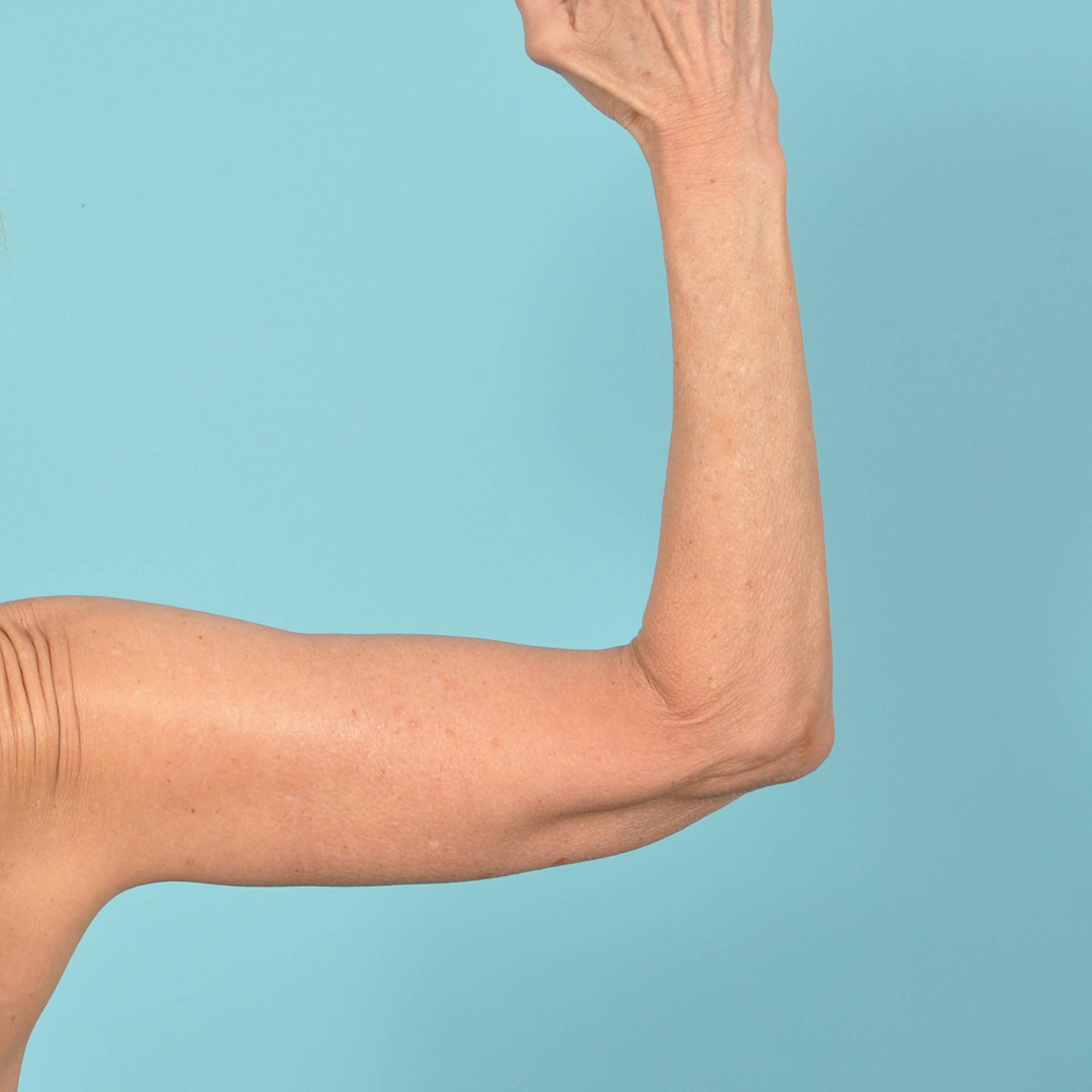 Arm Lift Before & After Image