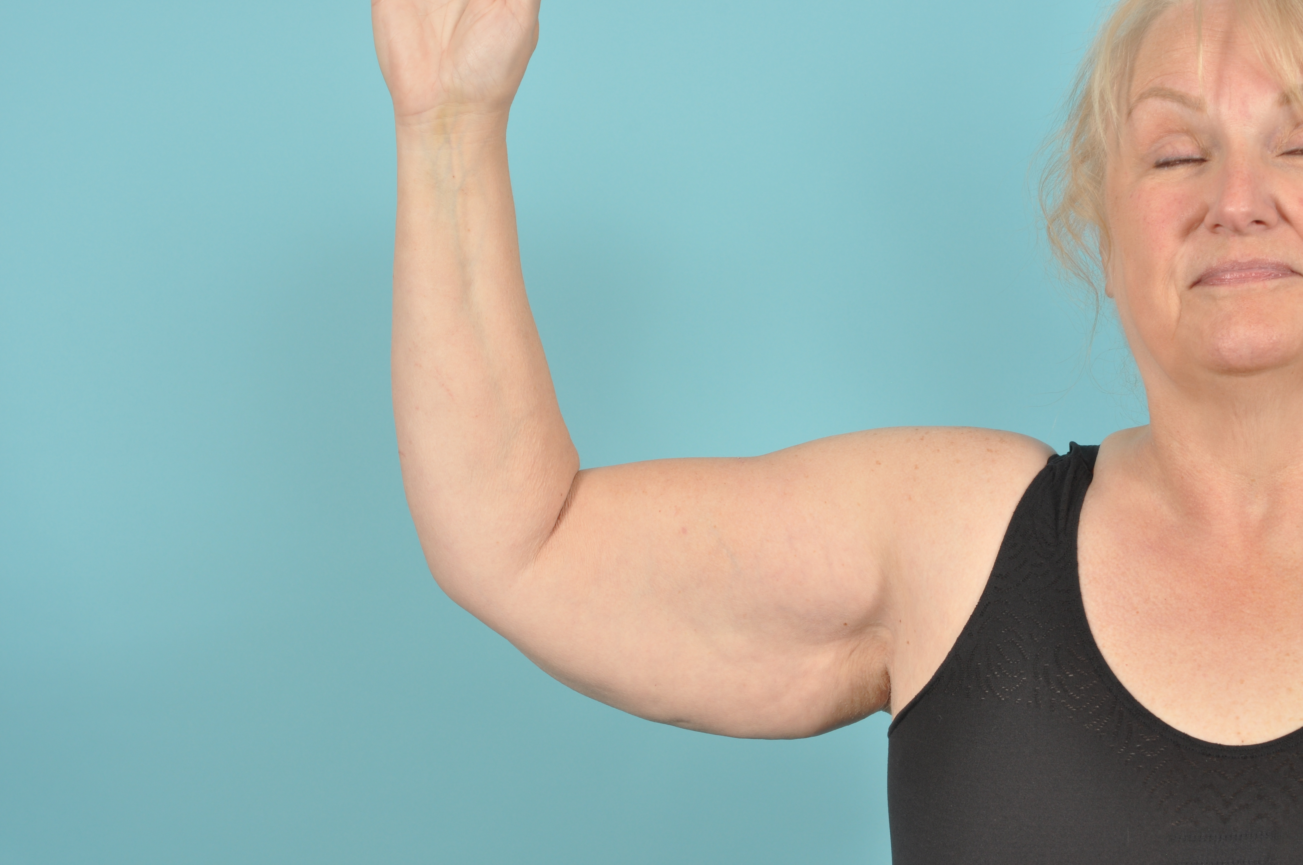 Arm Lift Before & After Image