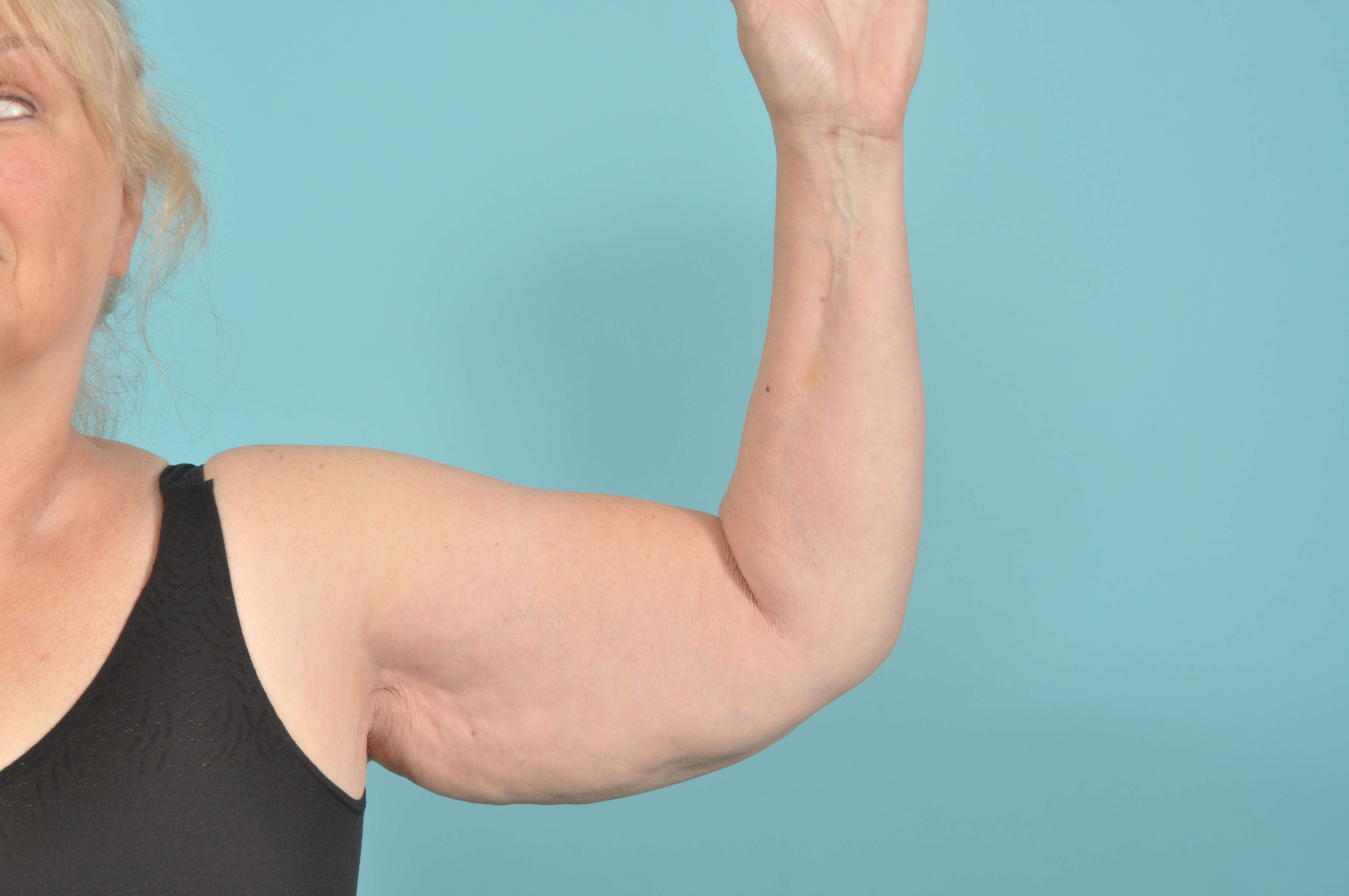 Arm Lift Before & After Image