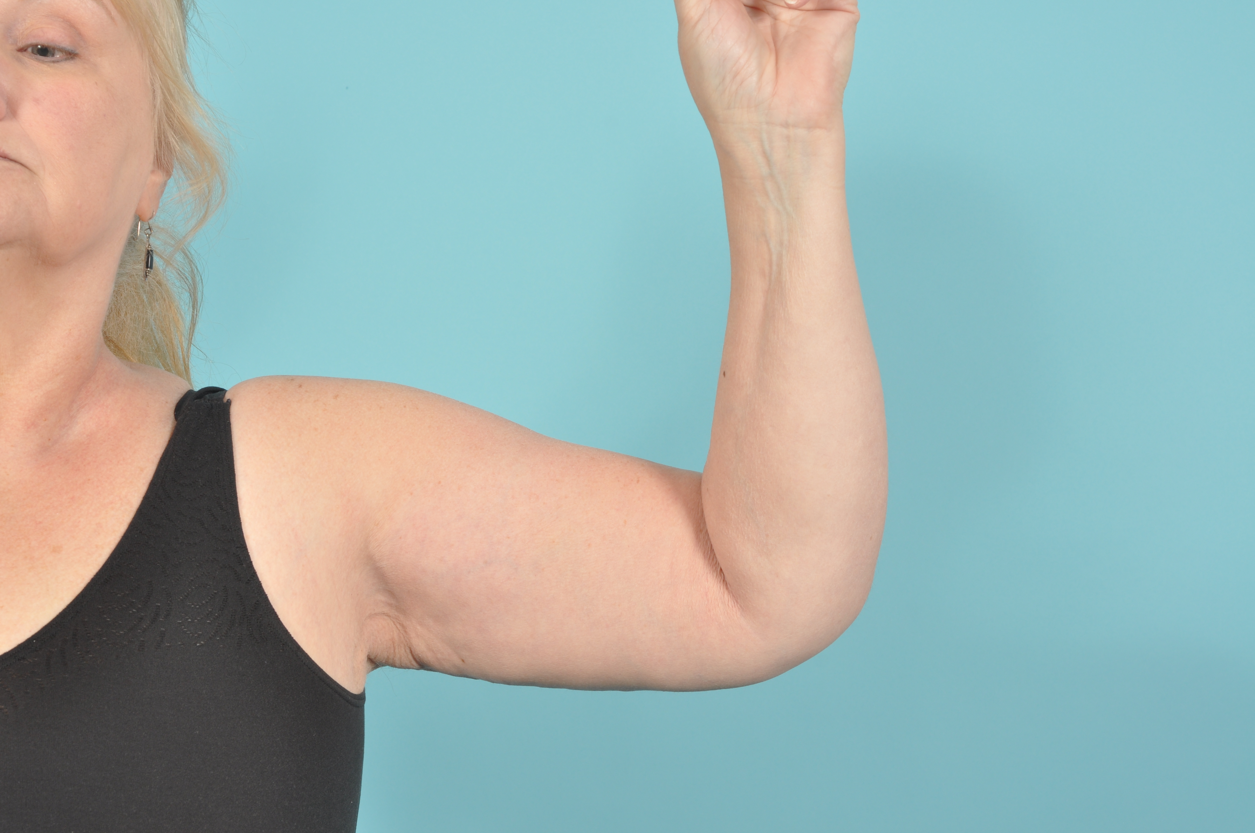 Arm Lift Before & After Image