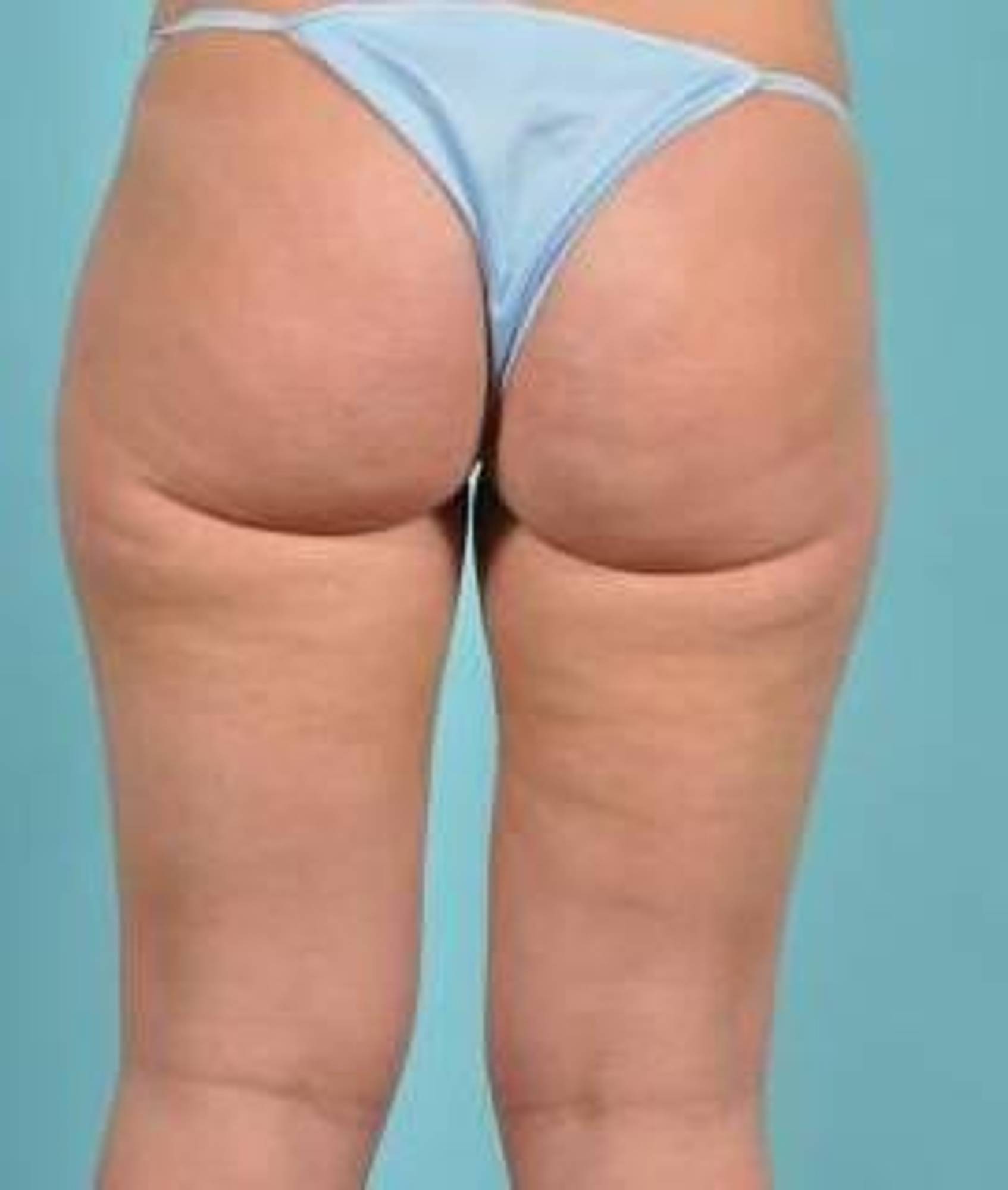 Cellulite Removal Before & After Image