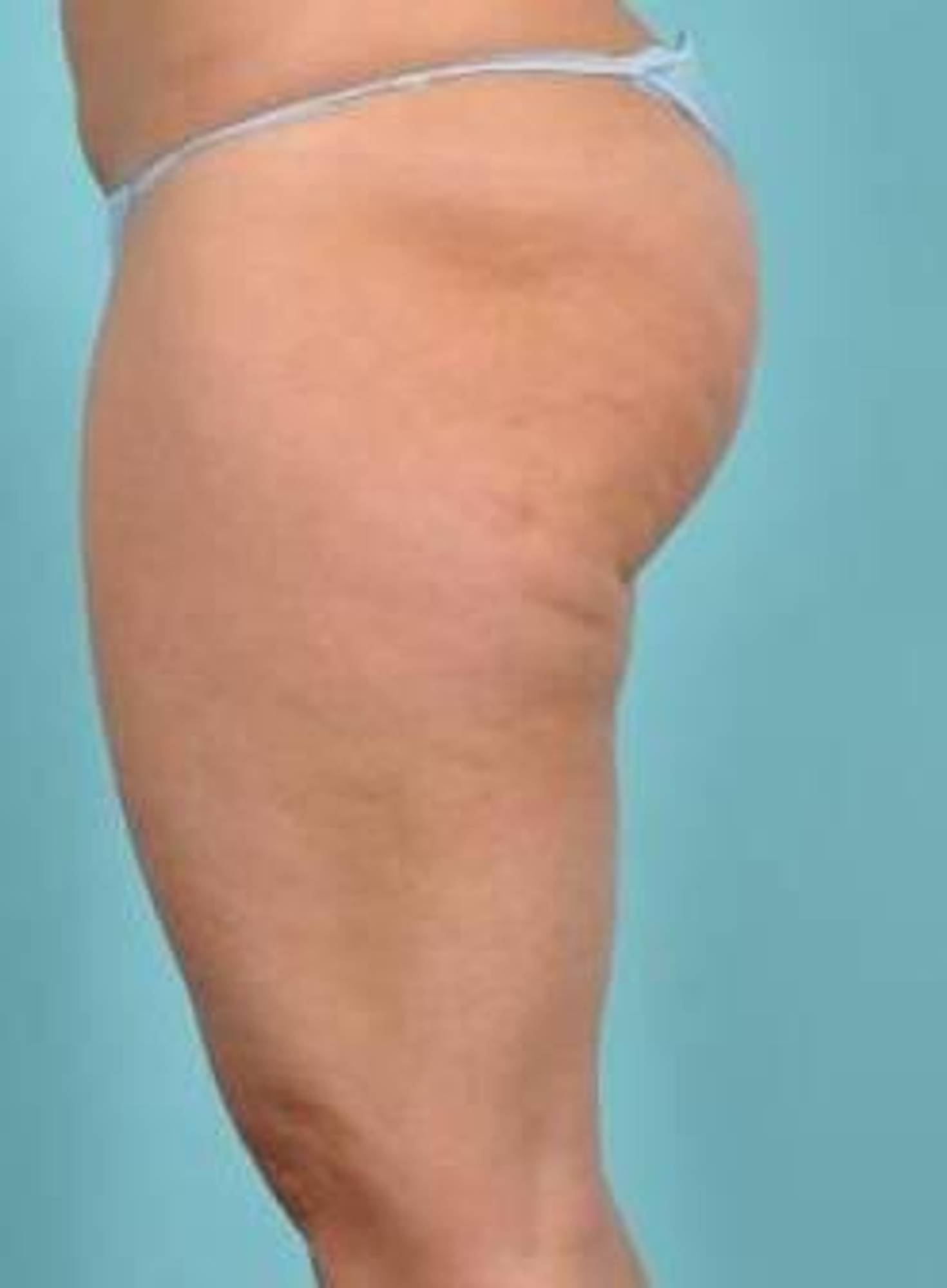 Cellulite Removal Before & After Image