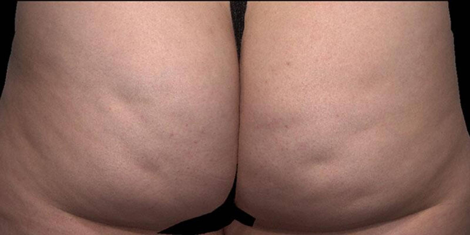 Cellulite Removal Before & After Image