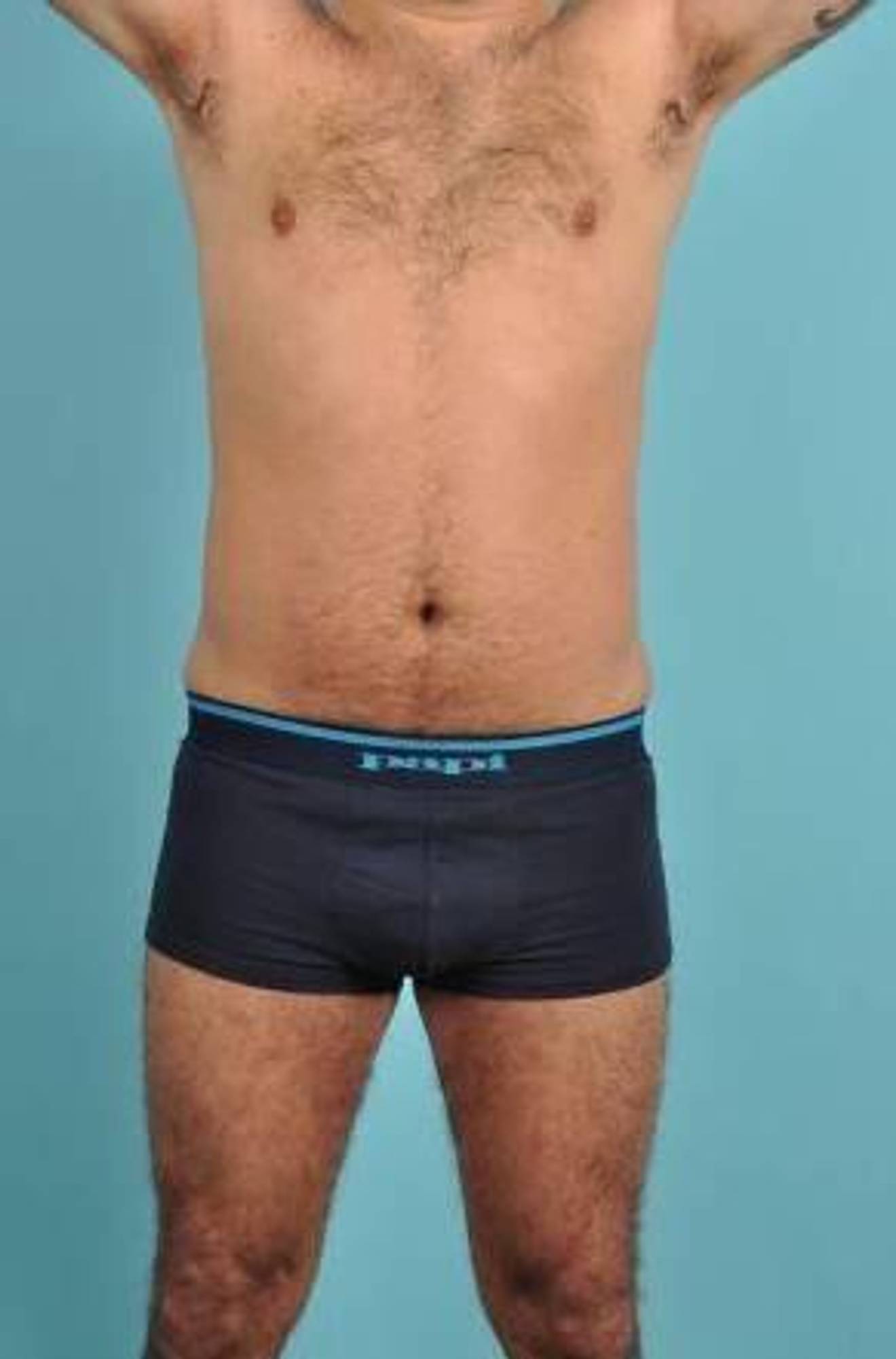 CoolSculpting Before & After Image