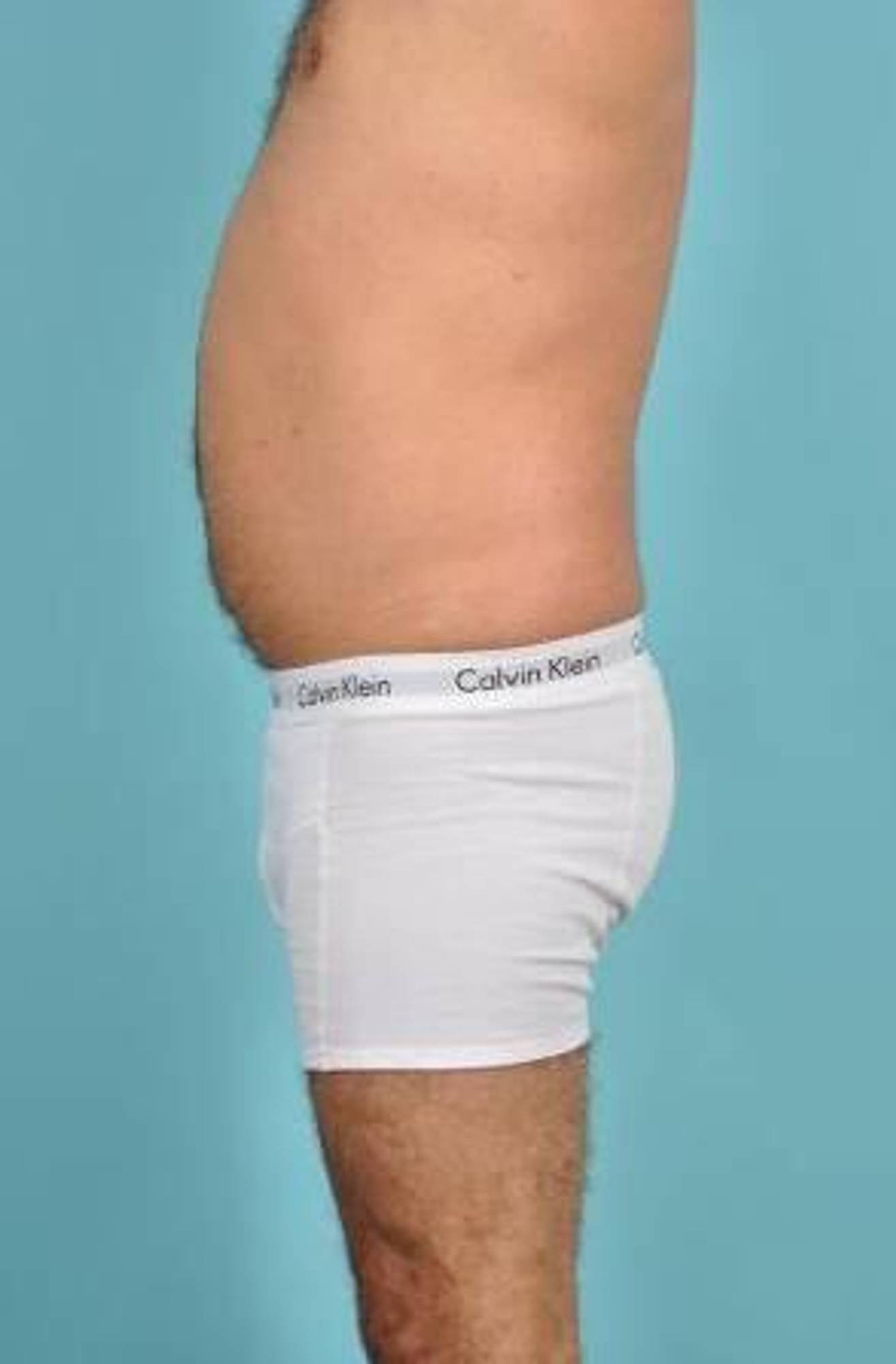 CoolSculpting Before & After Image