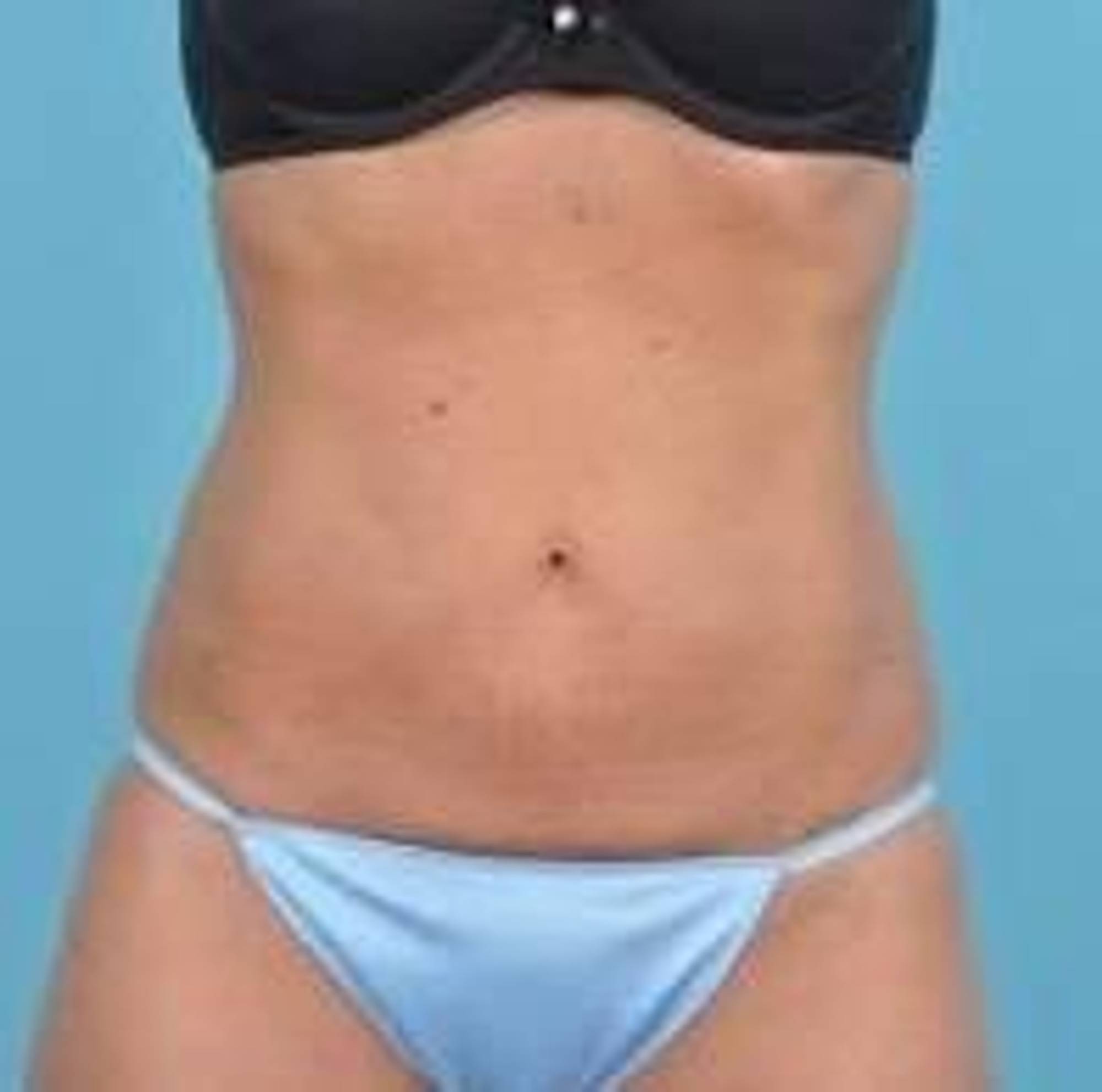 CoolSculpting Before & After Image