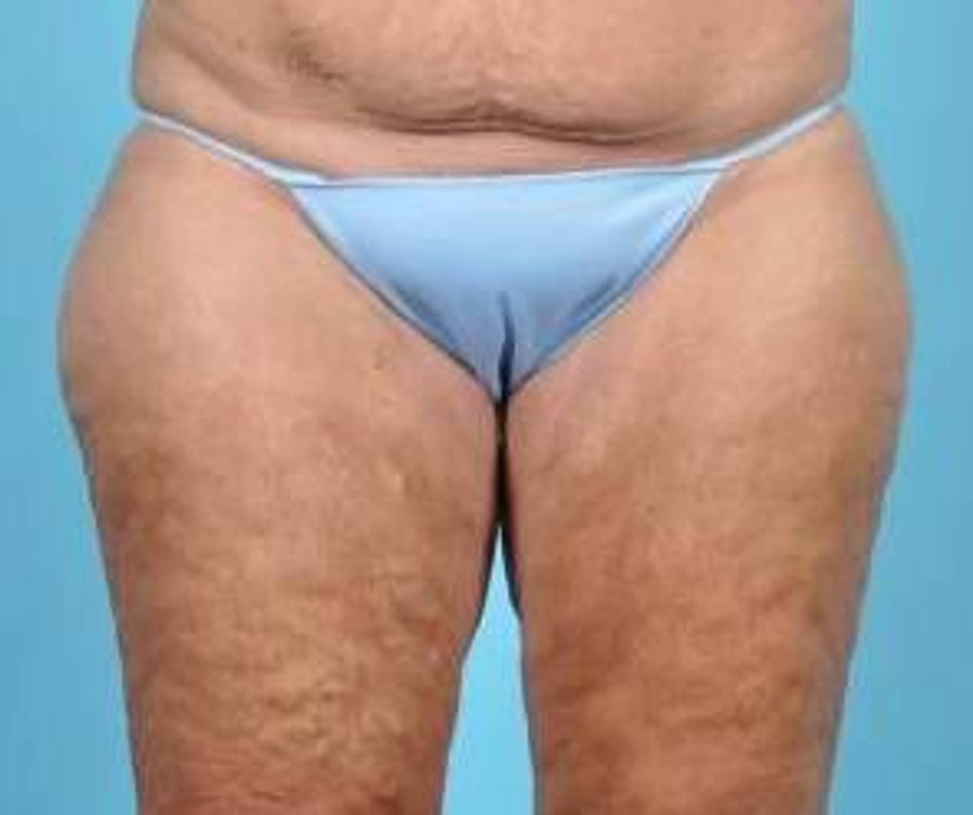 CoolSculpting Before & After Image