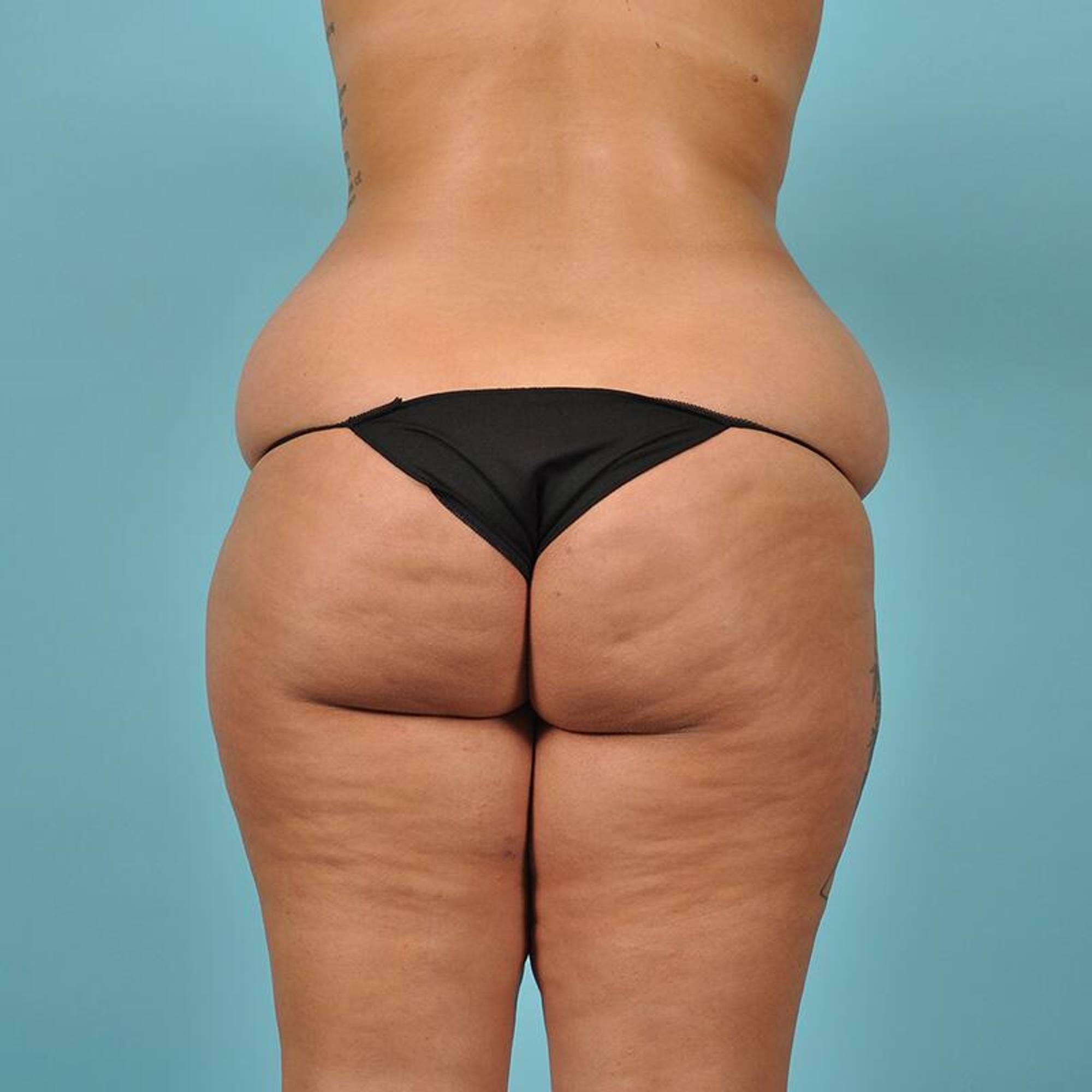 Fat Transfer Before & After Image