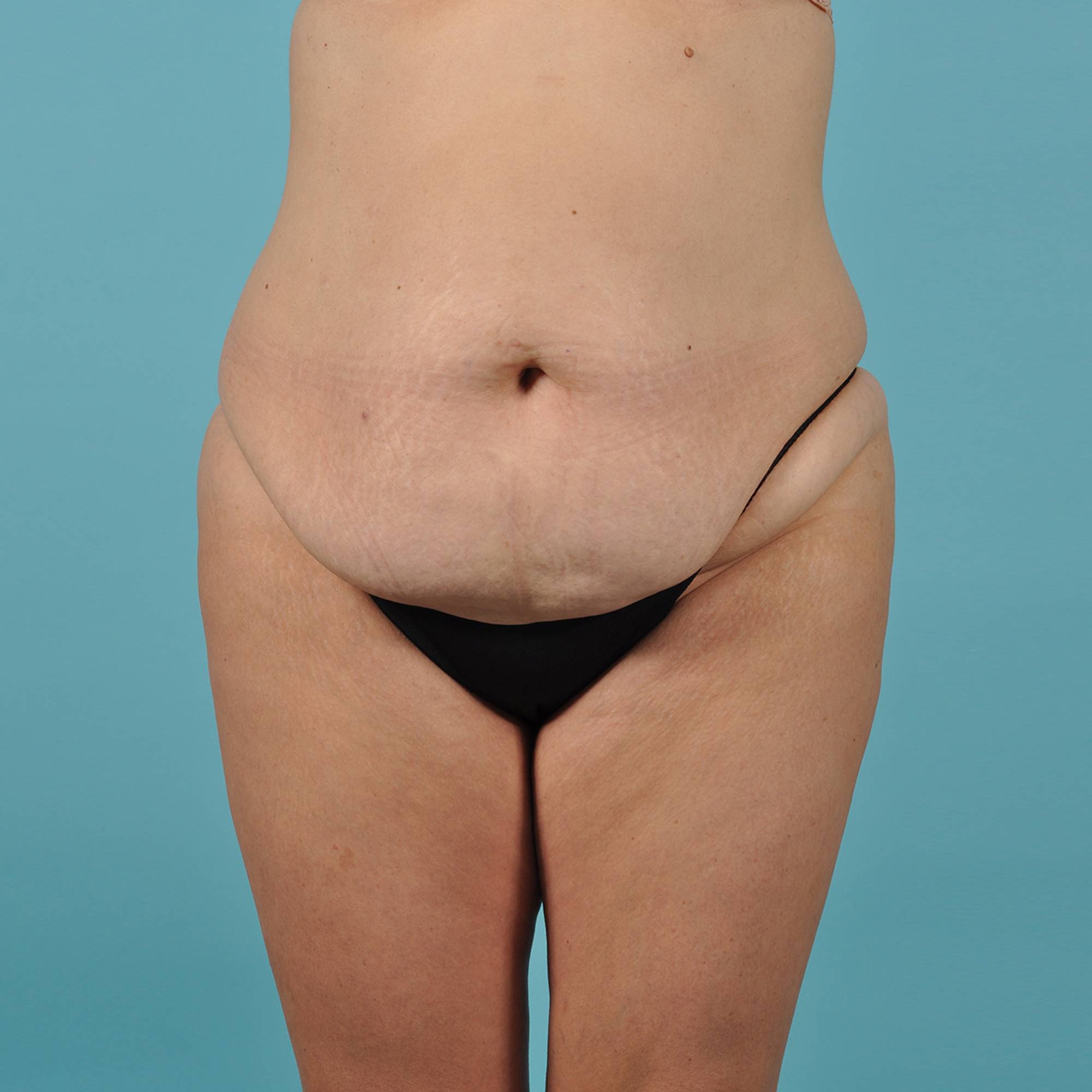 Fat Transfer Before & After Image