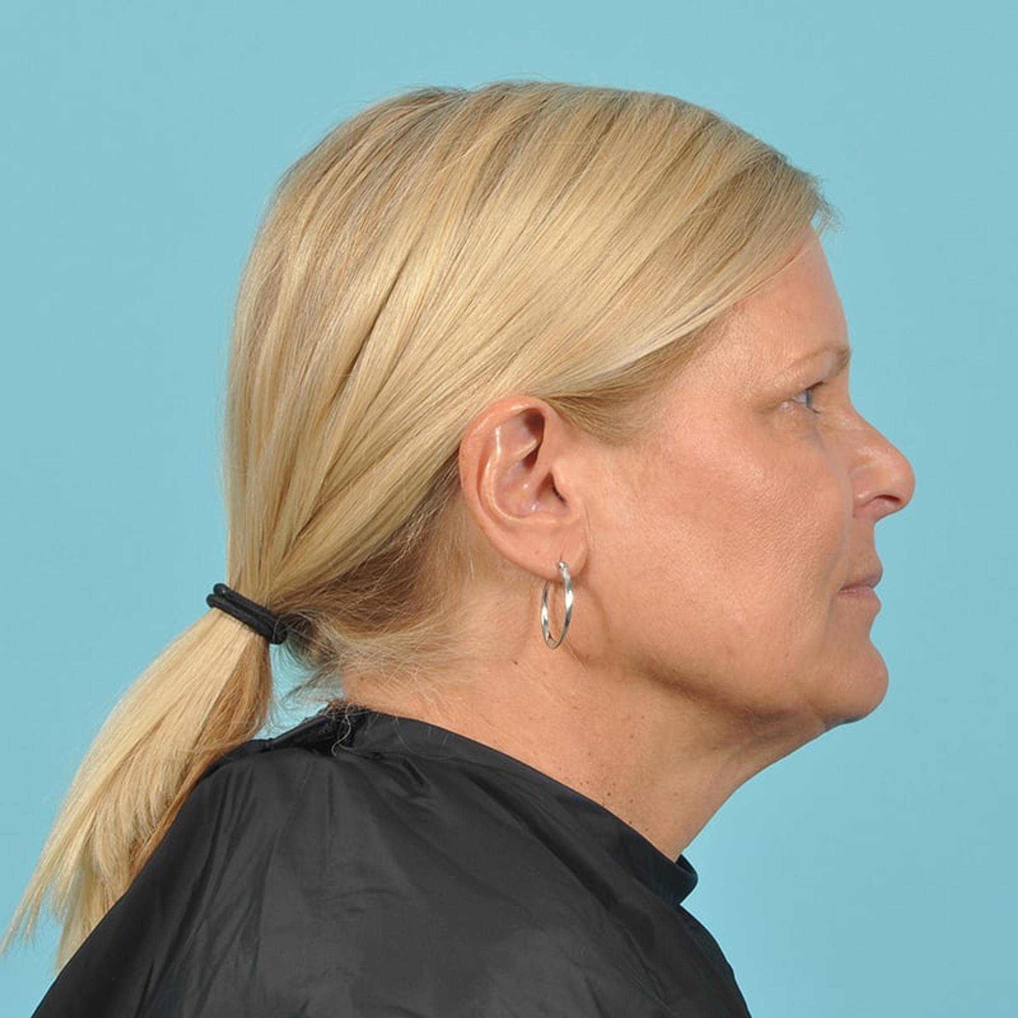  Before & After Image