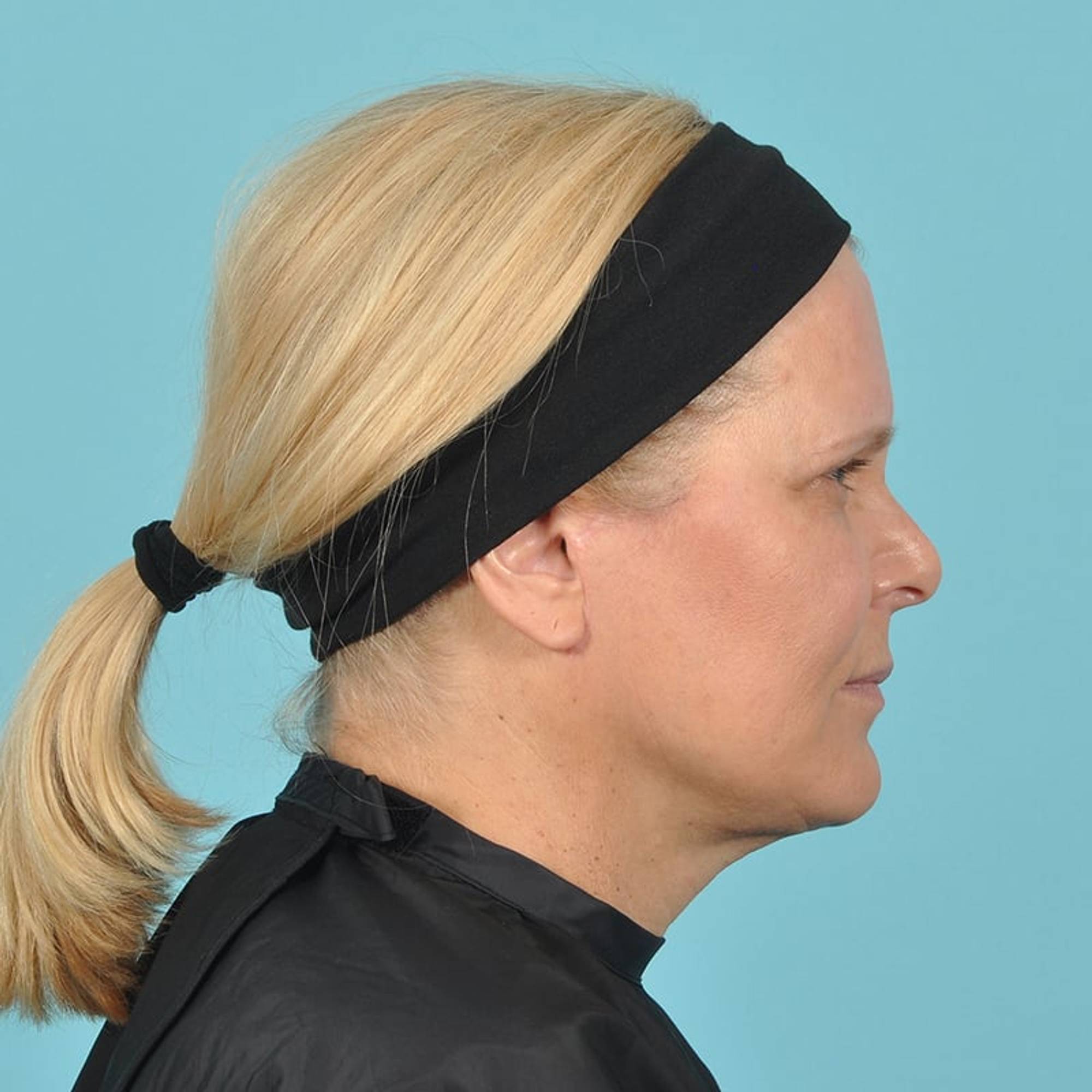  Before & After Image