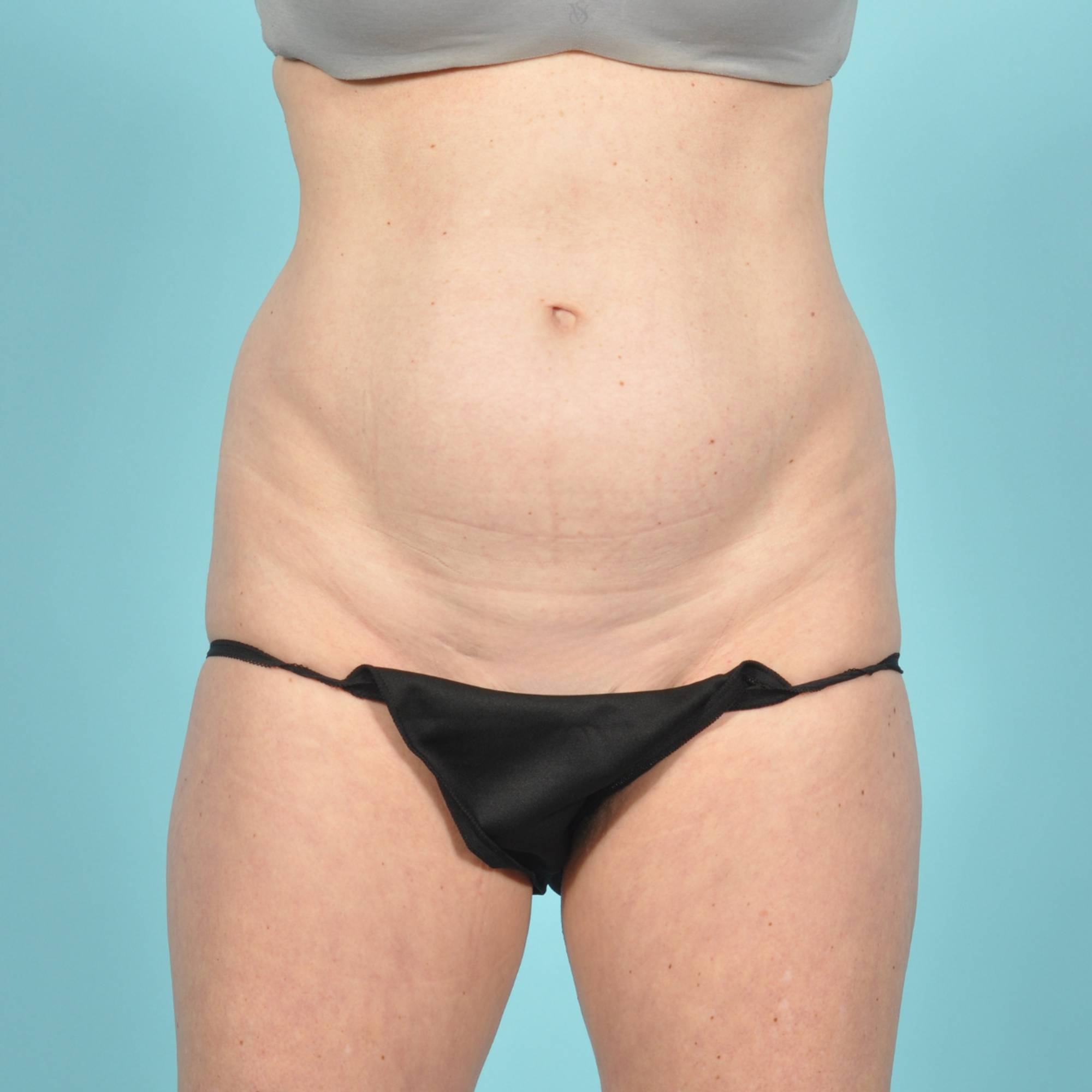 Liposuction Before & After Image