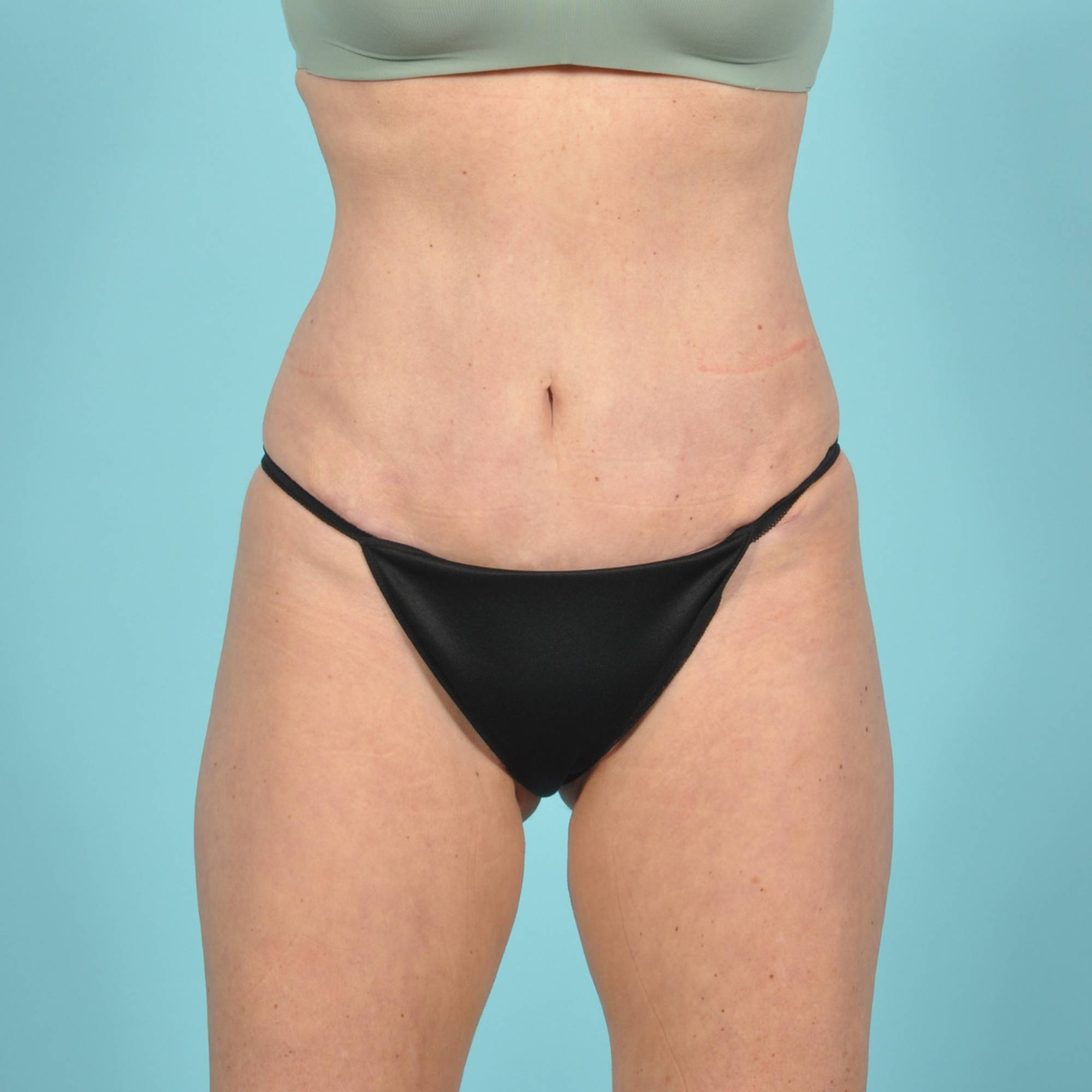 Liposuction Before & After Image