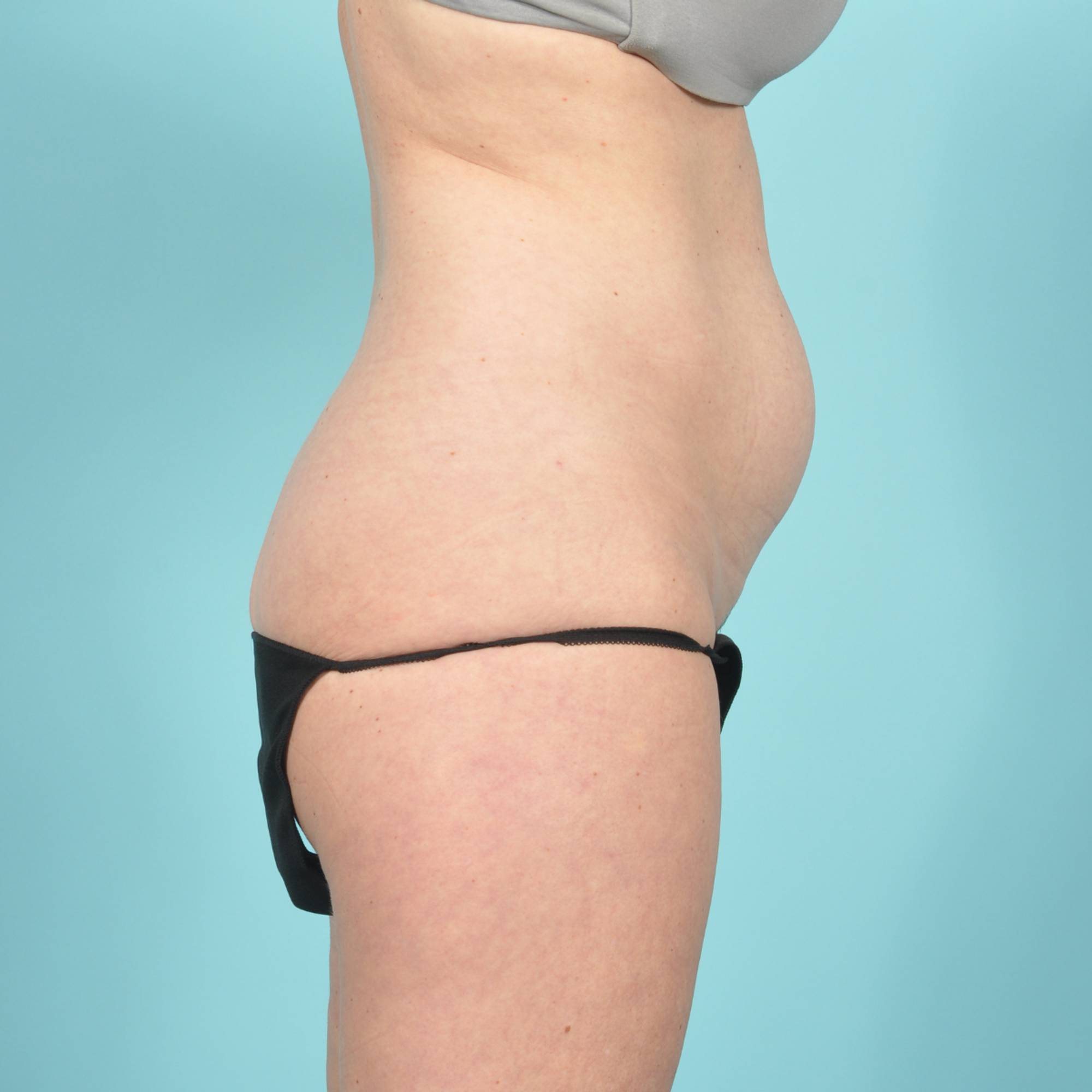 Liposuction Before & After Image