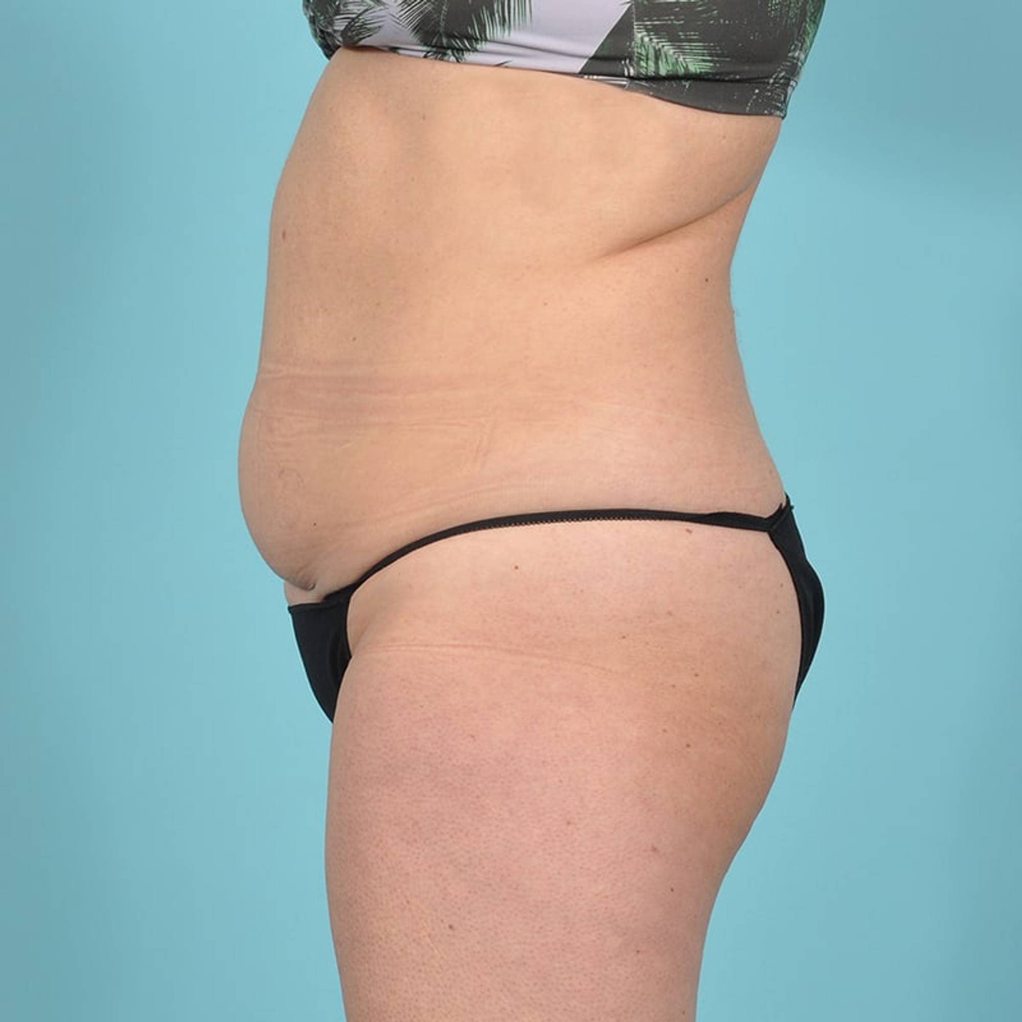 Liposuction Before & After Image
