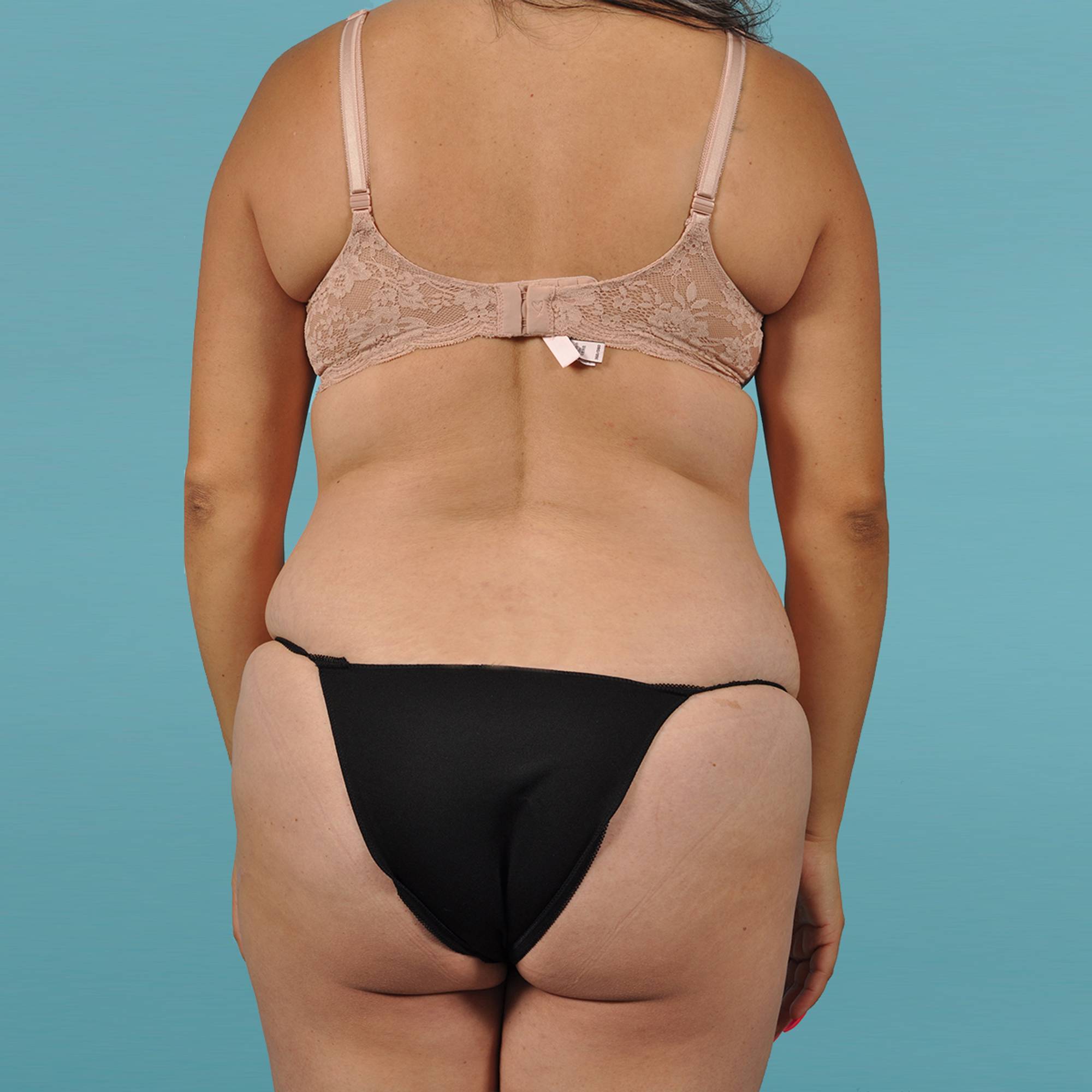 Liposuction Before & After Image