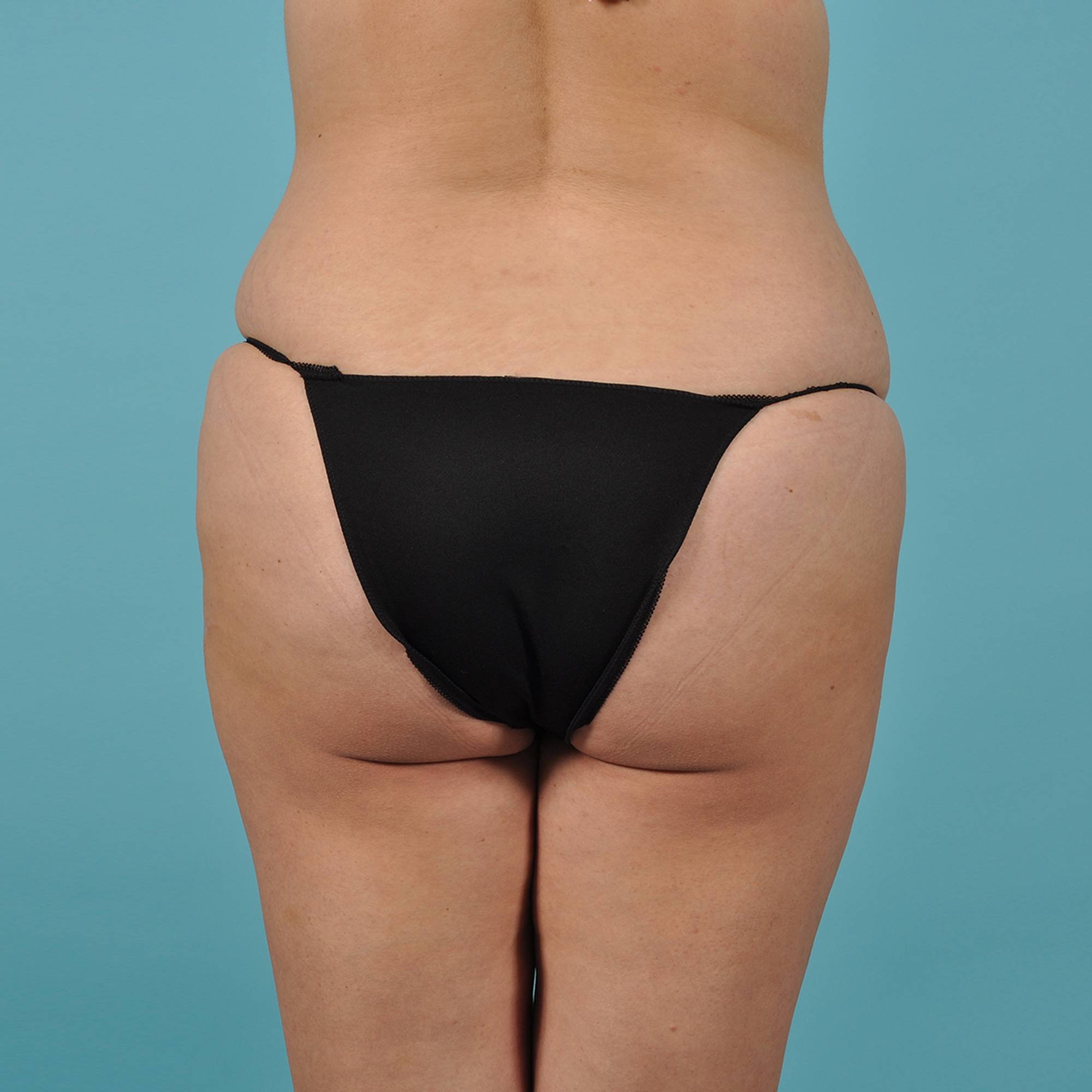 Liposuction Before & After Image