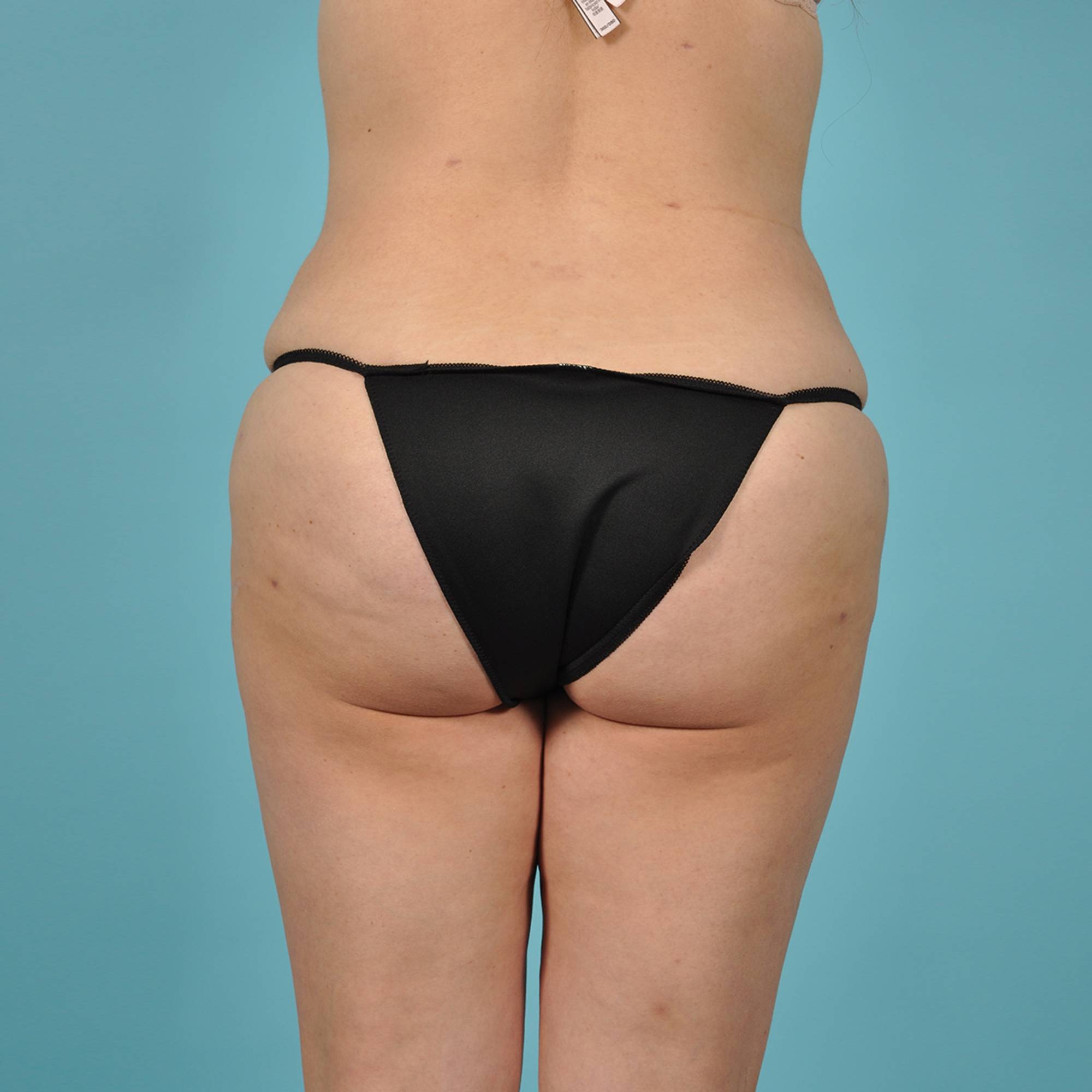 Liposuction Before & After Image