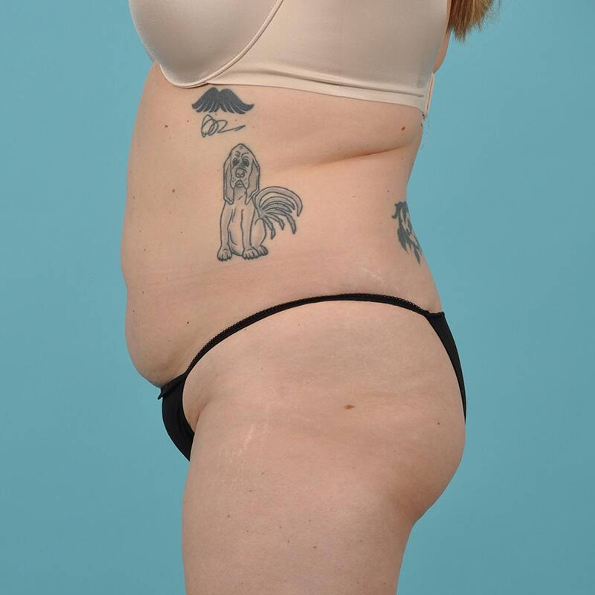 Liposuction Before & After Image