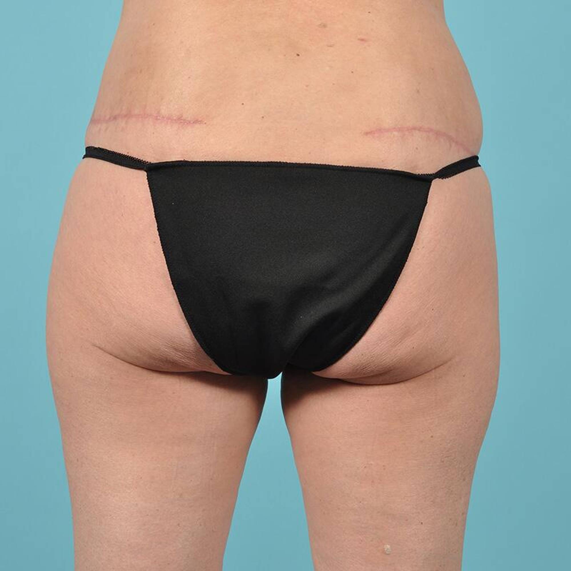 Liposuction Before & After Image
