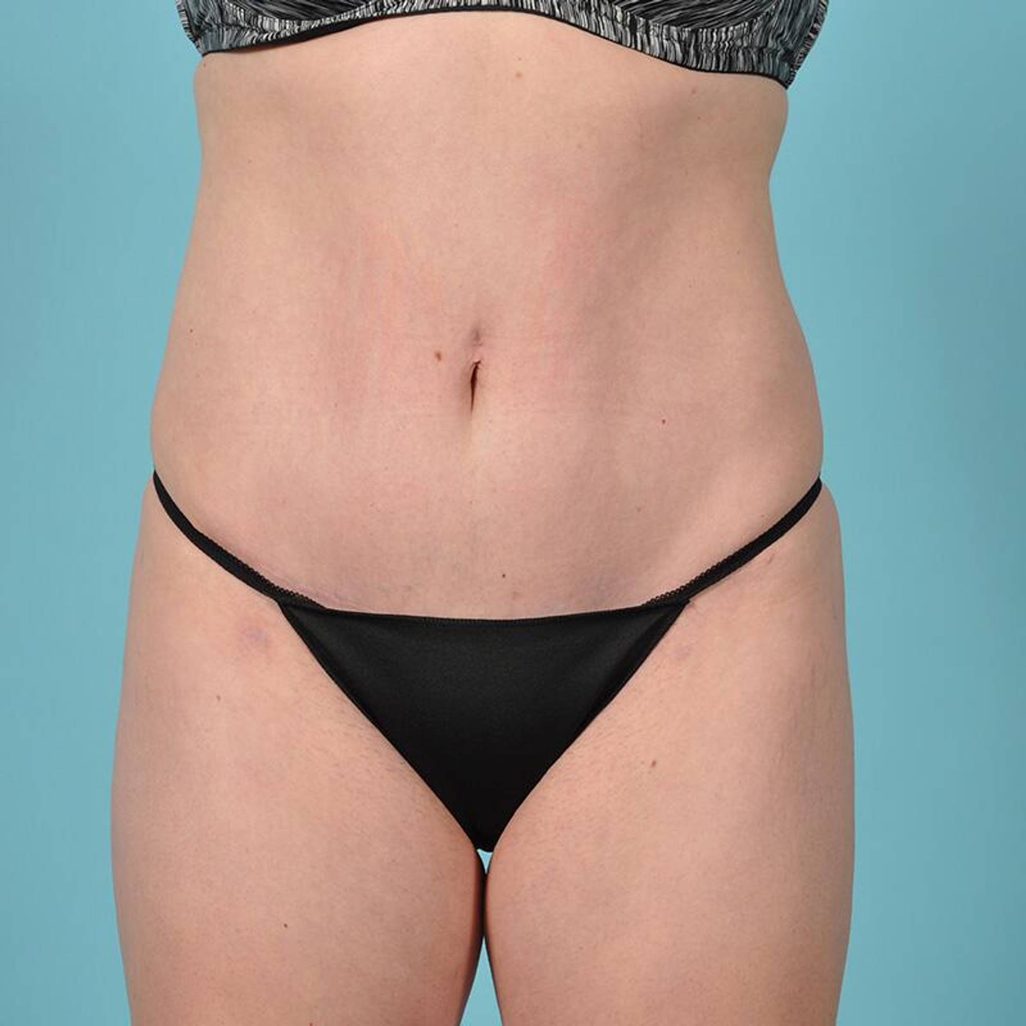 Liposuction Before & After Image