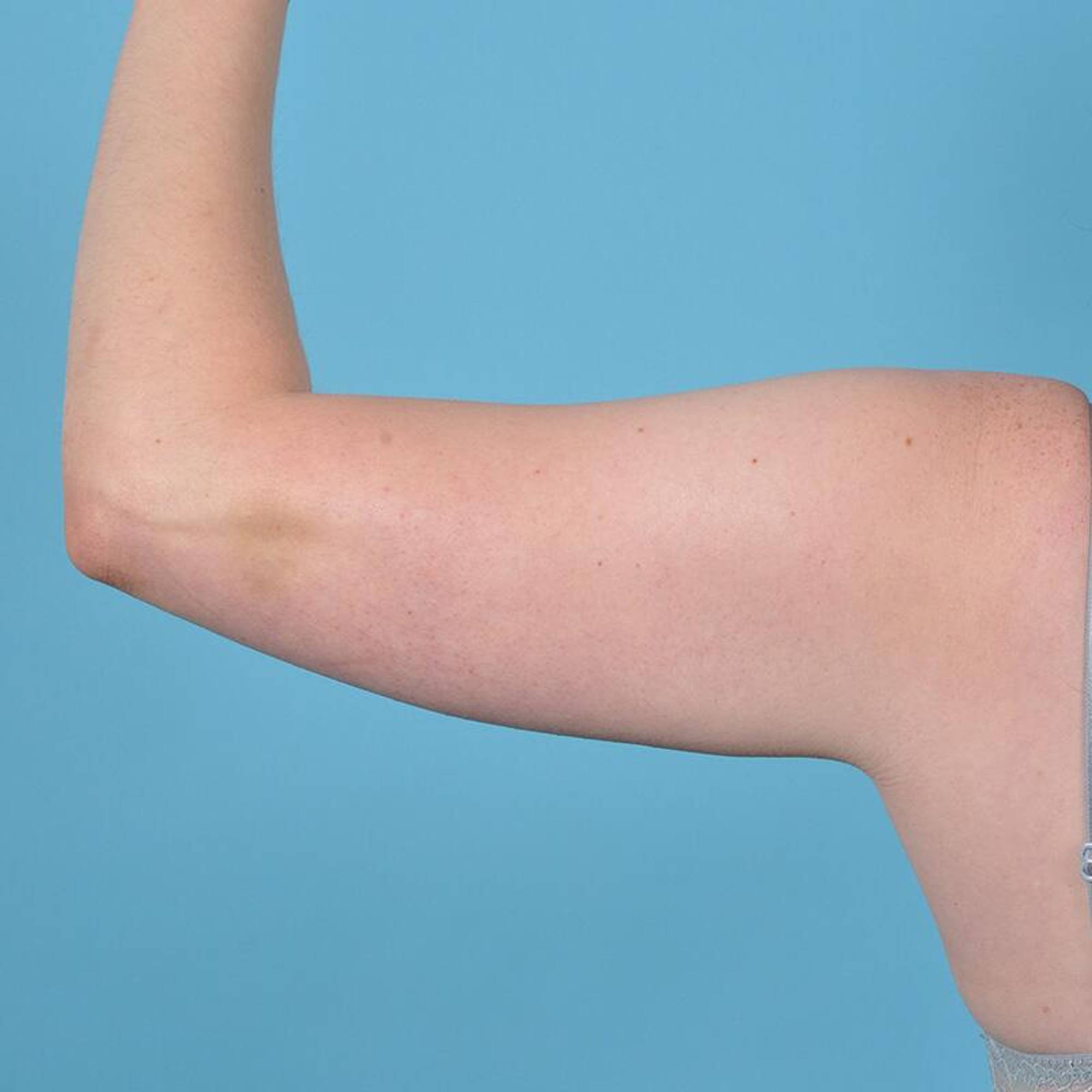  Before & After Image