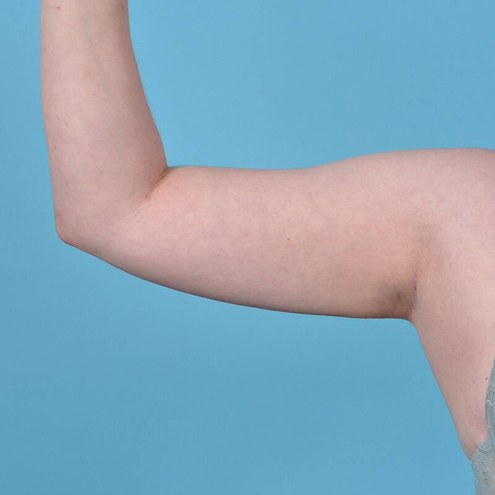  Before & After Image