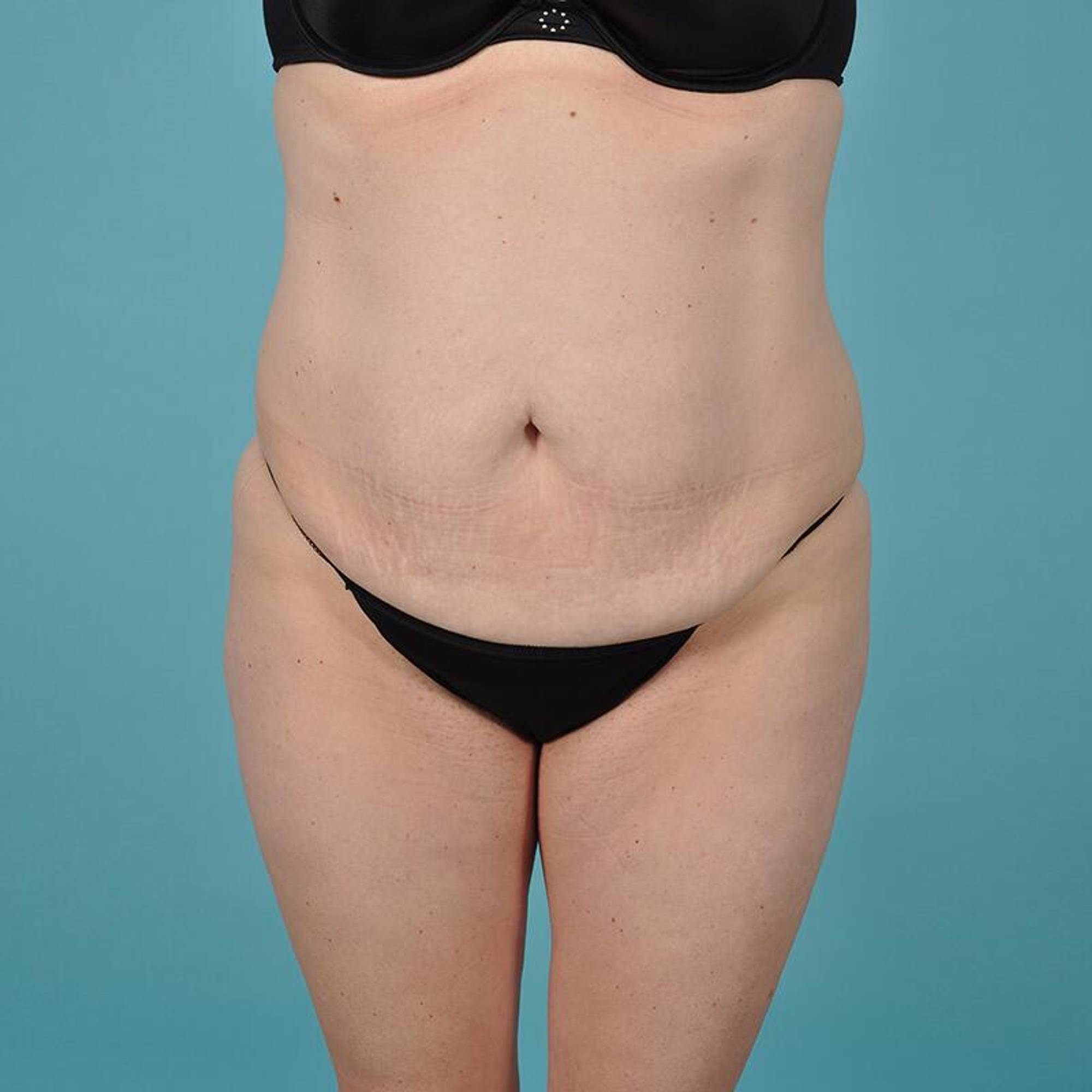 Liposuction Before & After Image
